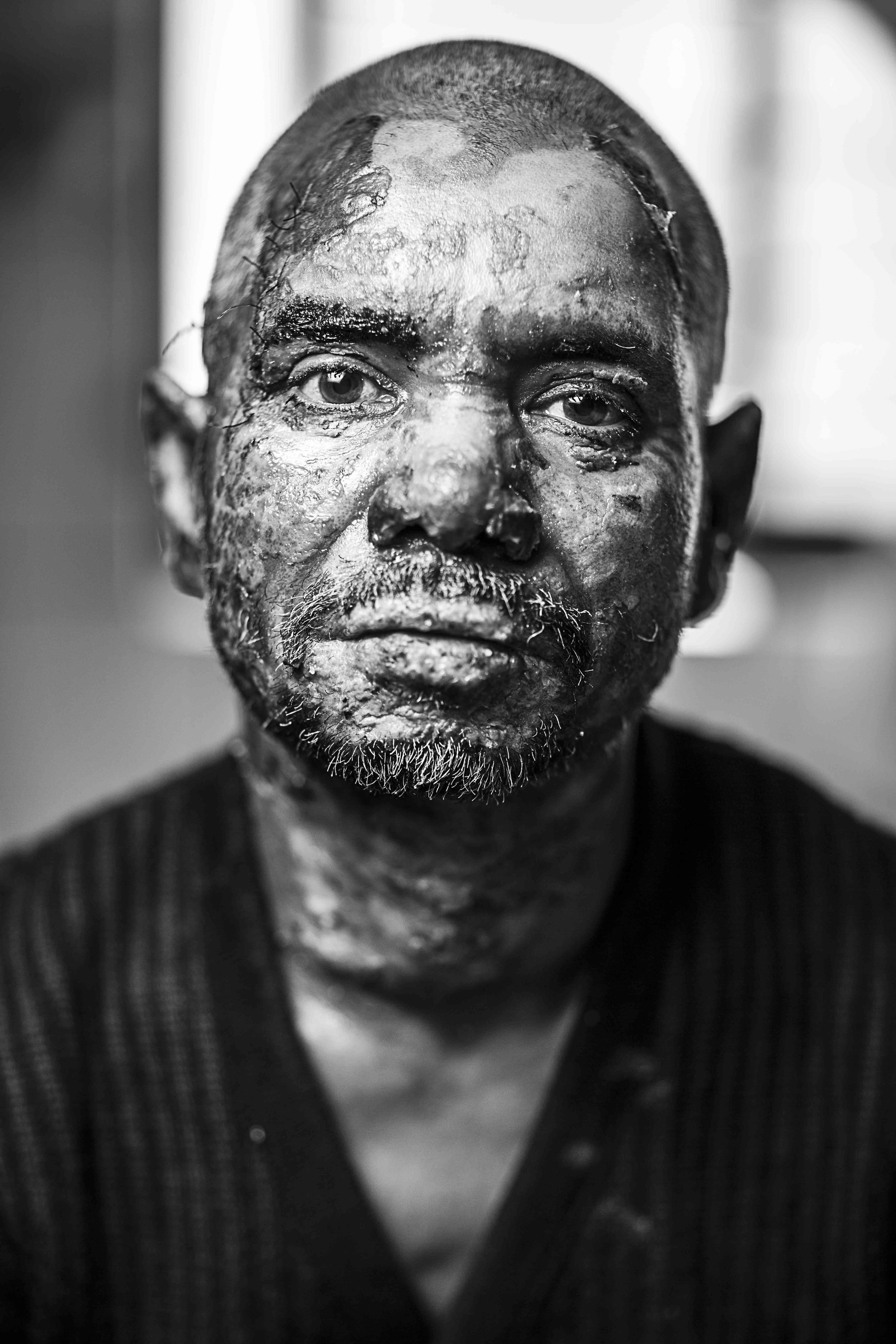  Lokman, 45 years old, a vegetable trader from Gazipur, received burns to 11% of his body, when miscreants threw a petrol bomb onto a truck he was travelling on he was admitted to Dhaka Medical College Hospital (DMCH) on the 2/1/2014.      
