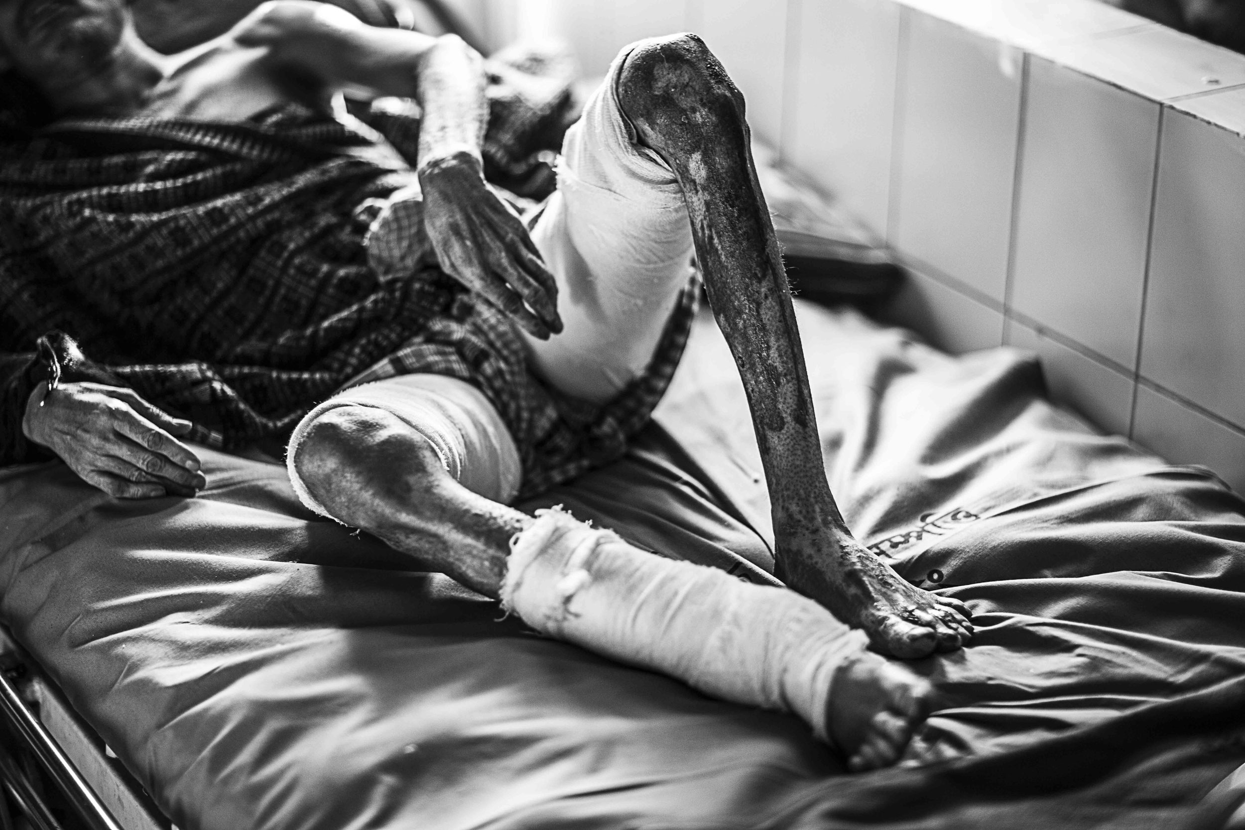  Mohammad Rubel Mia’s burns to his legs struggle to heal, his dressings are supposed to be changed numerous times throughout the day, however he is lucky if they are changed once due to the amount of people in the burns unit and lack of staffing.    