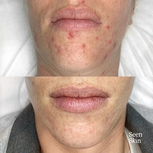 THE CHIN βοΈβοΈ SO MUCH DRAMA. Clients be like, “the rest of my skins ok, but see my chin?” It’s so common π¬β£
β£
Where you’re breaking out, what it looks like, how often it breaks out, how slowly it heals and loads of other thin