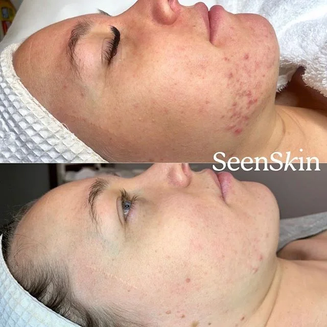 DREAMY β¨β¨β¨ β£
β£
Scarring, congestion, problematic chins! We work on the premise that when the skin is happy and healthy it knows what to do, so bringing the balance is what we’re about. A 3 step skin care regime, gut loving supps, a couple of ho