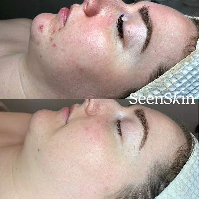 HAPPY SATURDAY β‘οΈβ‘οΈβ‘οΈ “As a 26 year old these type of breakouts should not be happening to me” ππΌ No they shouldn’t. Something (or a few things), are out of balance. See βπΌβπΌ how we worked on the skin barrier first (the redness)