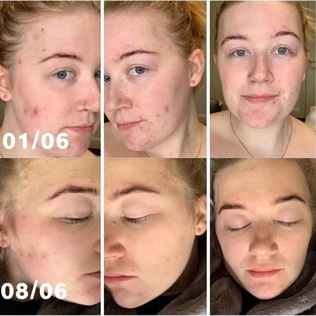 Yay Taneal ππ½ππ½ππ½ Combo of skin care (3 steps), gut loving supps and a great professional treatment regime that we’ve adjusted at each stage β¨