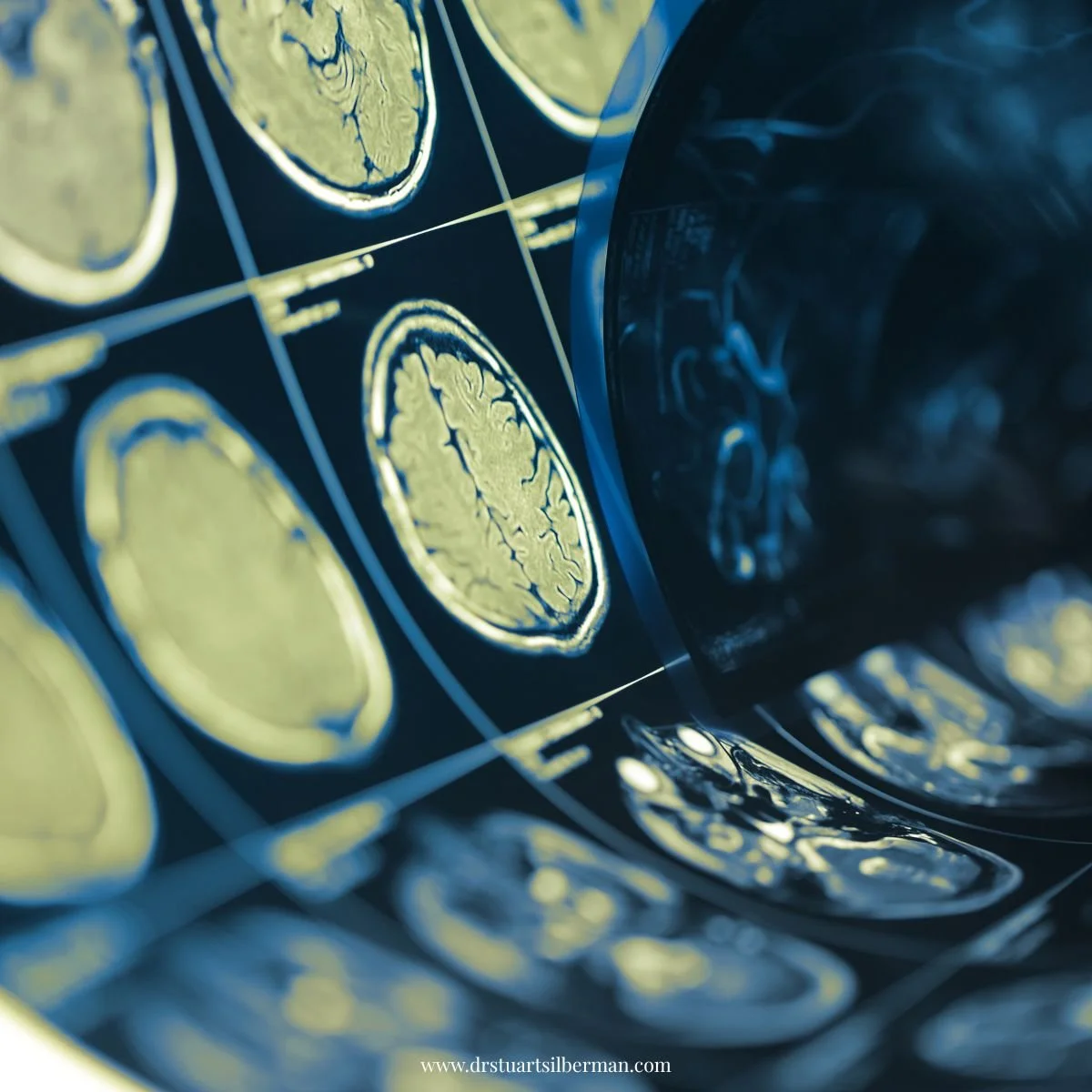Neurofeedback for Concussions
