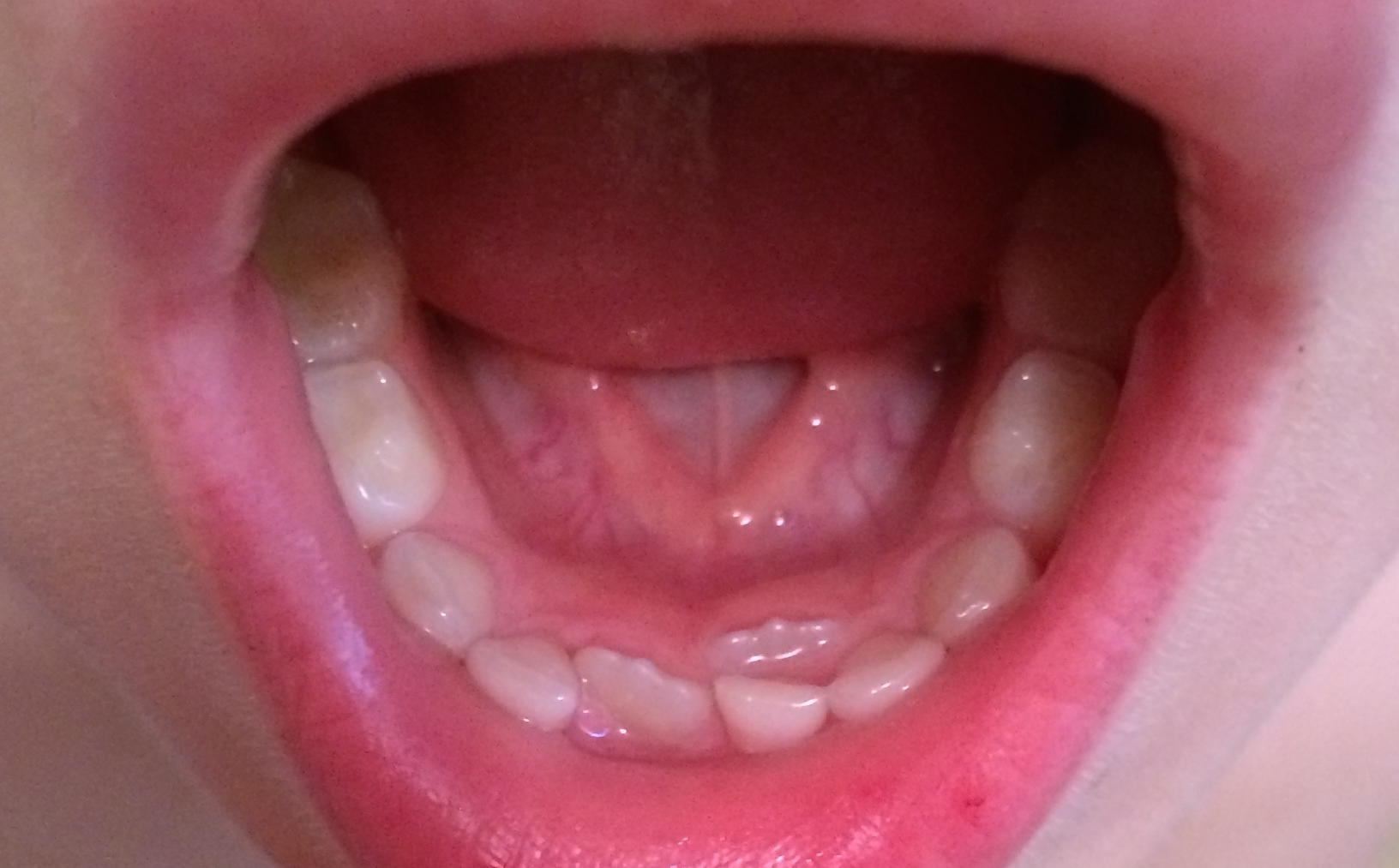 Look closely for the adult tooth coming in BEHIND the baby teeth in the bottom row.