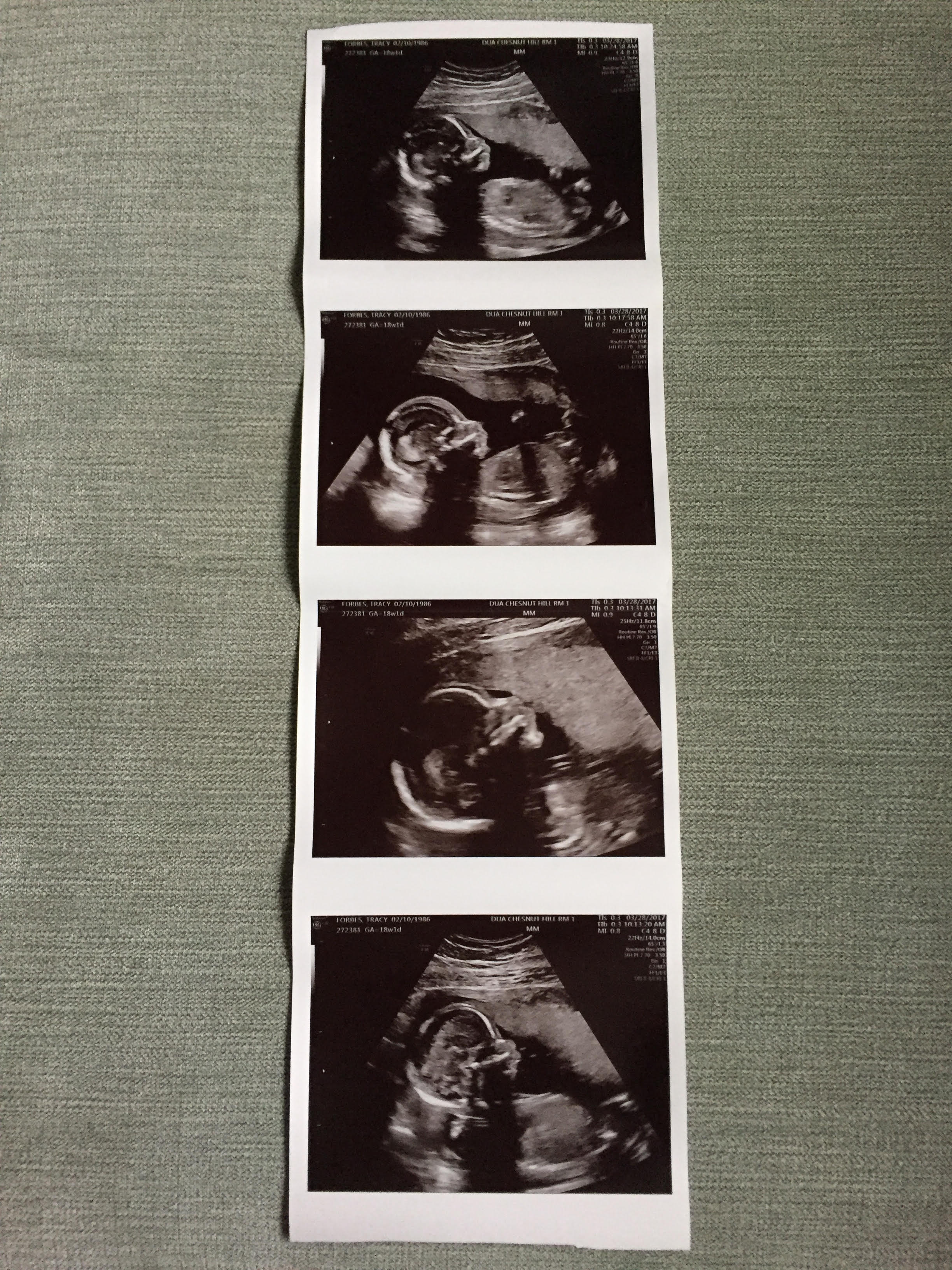 Baby Boy at 18 weeks!