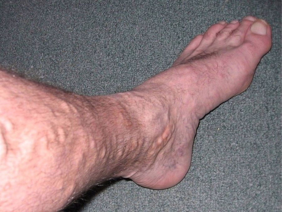 edema picior varicoase vene)