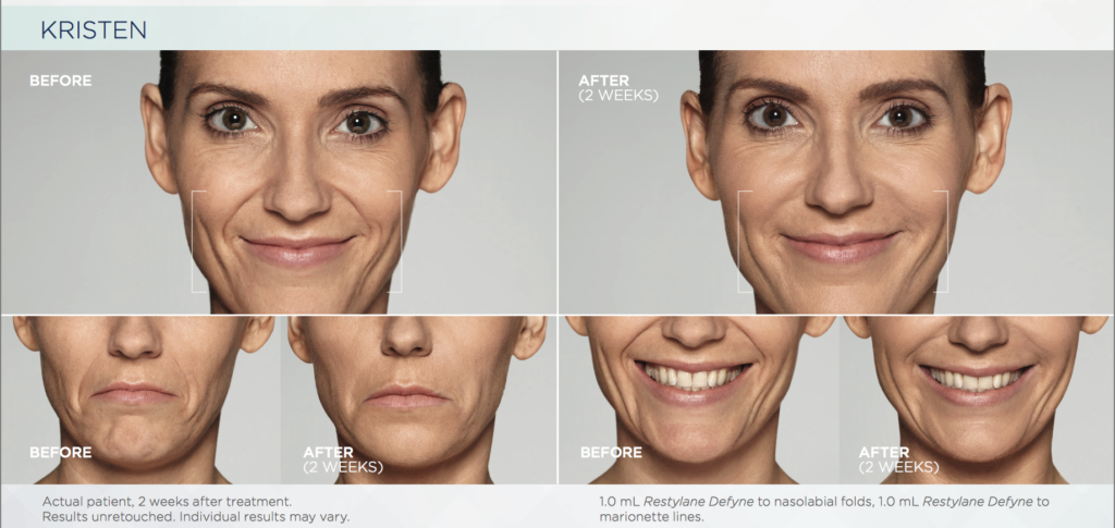 restylane refyne defyne kristen.png