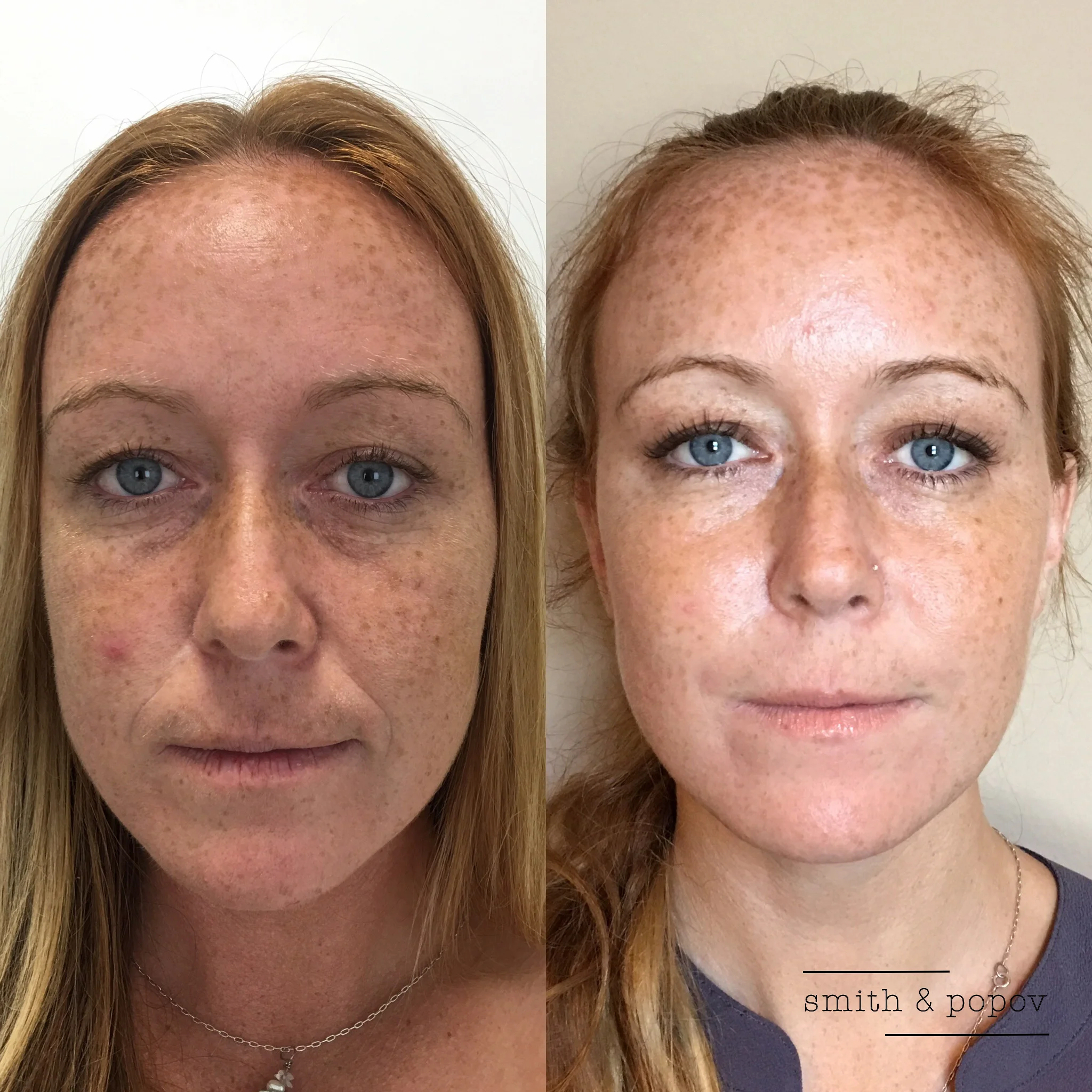 cheeks_Voluma_NLF_Juvederm.jpg