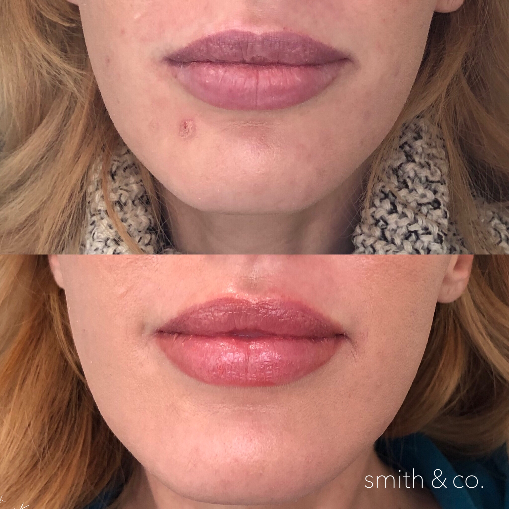 lips with juvederm and volbella