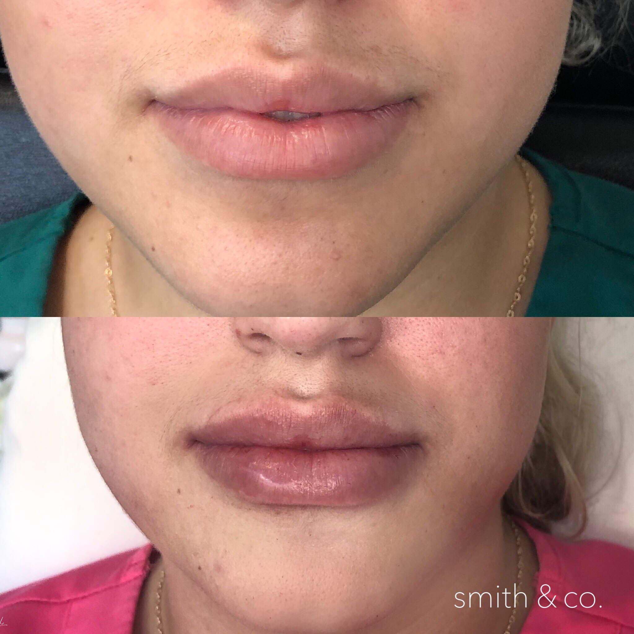 smith & co best lip fillers in miami juvederm plump.PNG