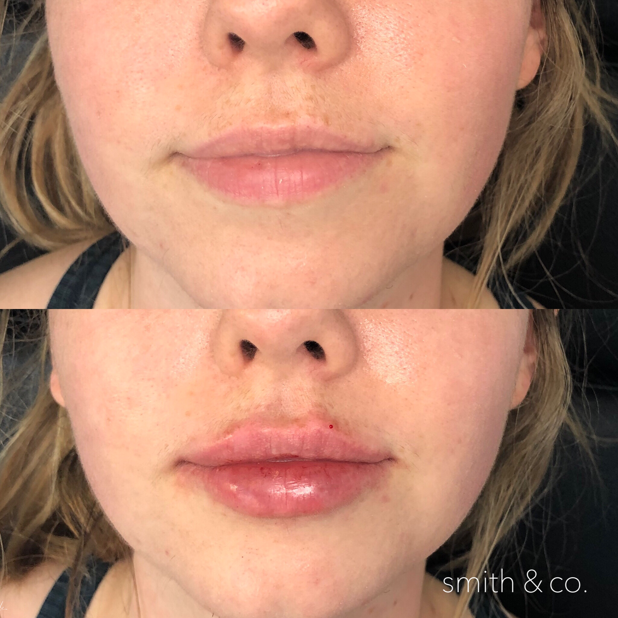 smith & co best lip fillers in miami restylane contour.PNG