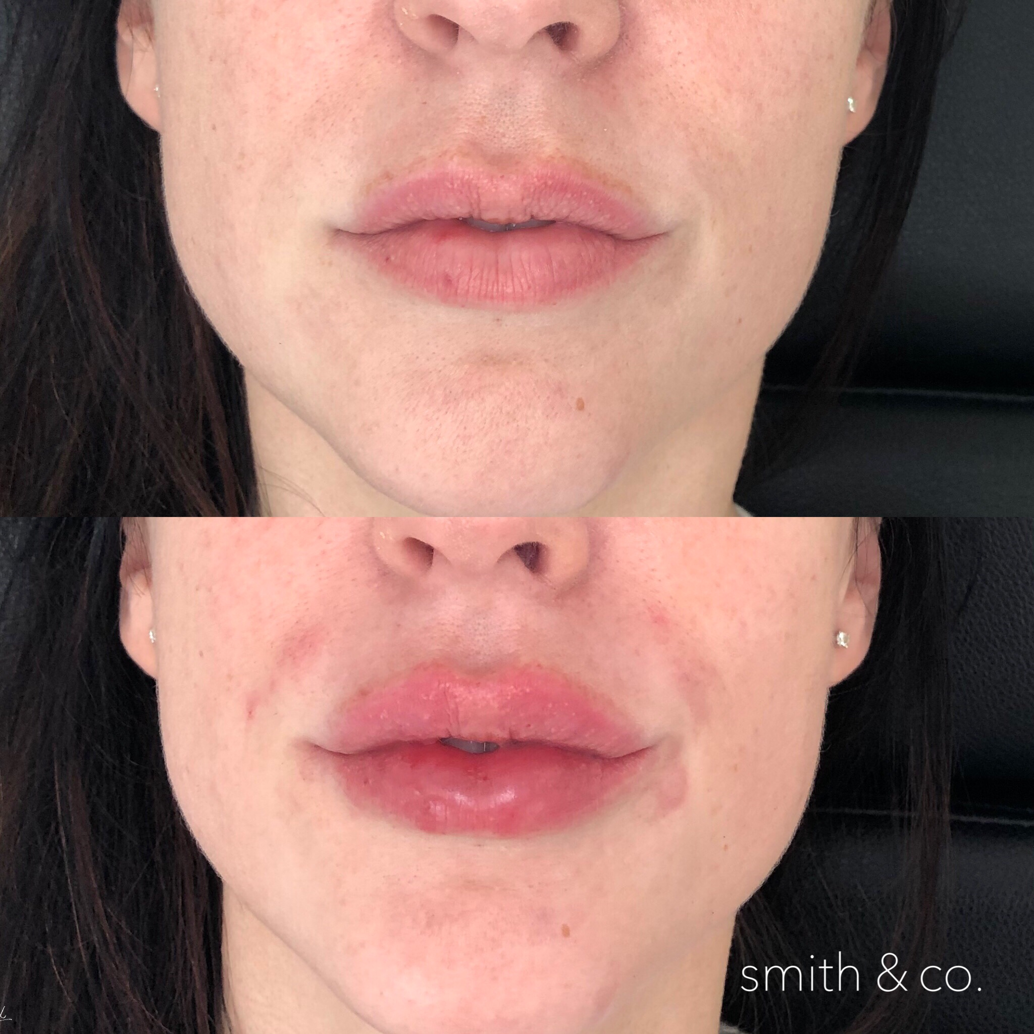 smith & co best lip fillers lip injections in miami beach best botox specialist 4.PNG