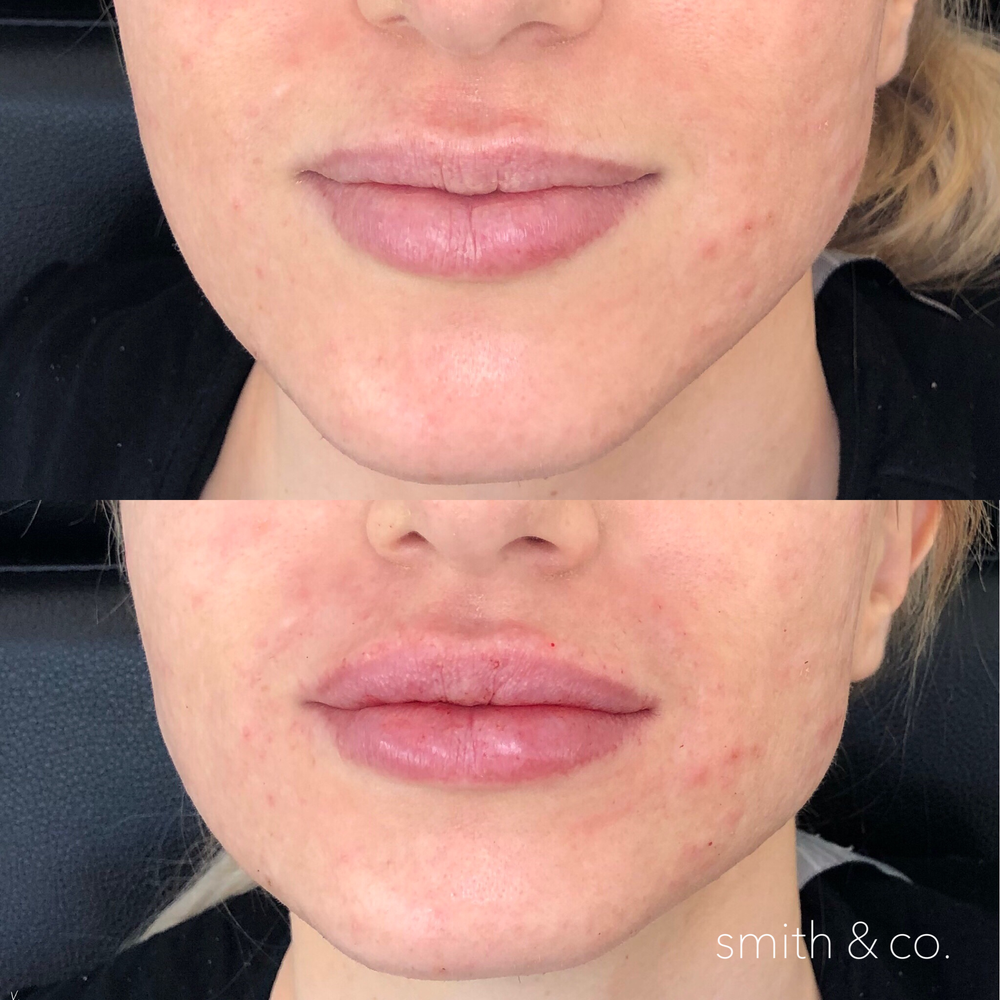 Lips Miami Beach Botox Specialist