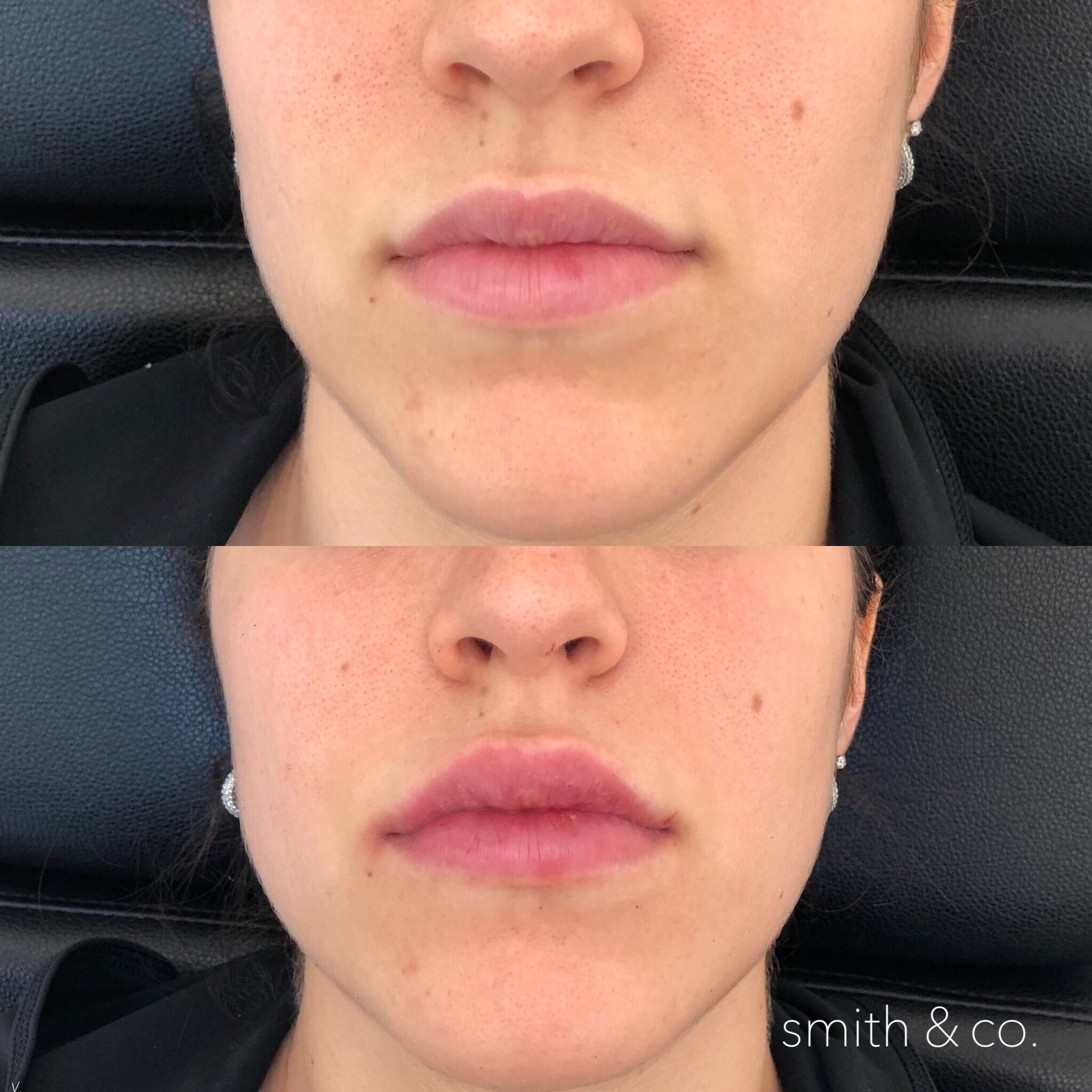 smith & co best lip injections in miami lip balancing.PNG