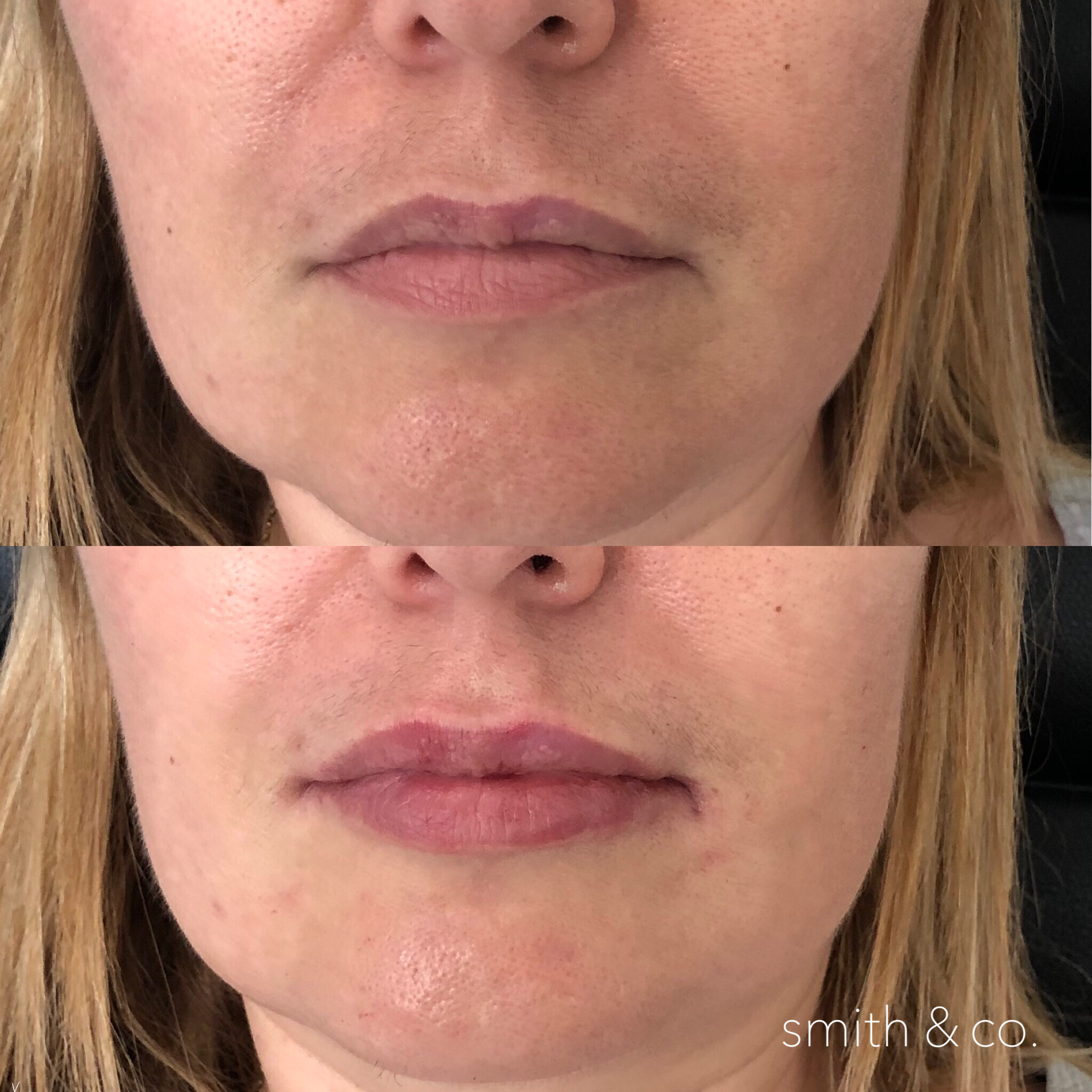 smith & co best lip injections in miami restylane lips.PNG