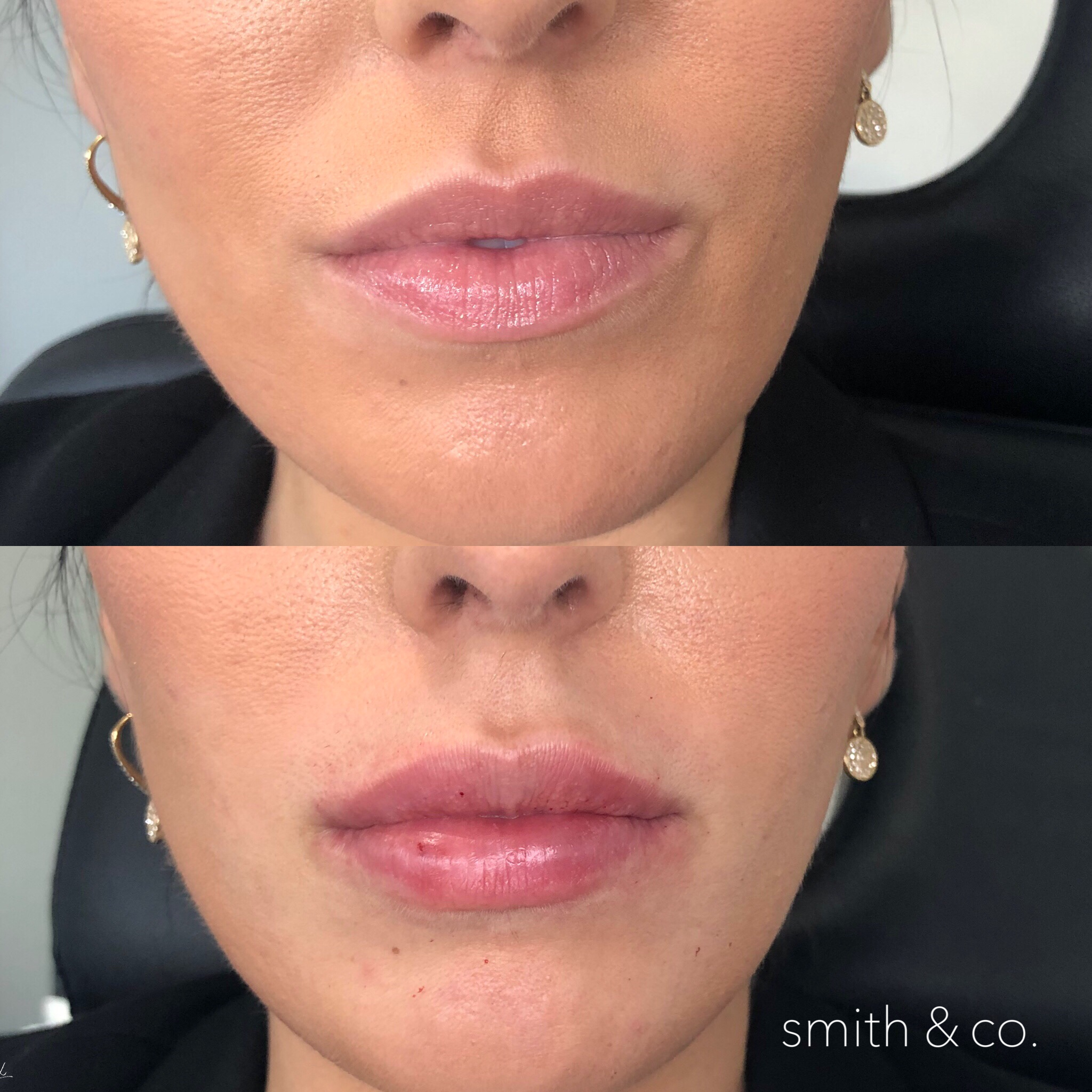smith & co best lip injections in miami.PNG