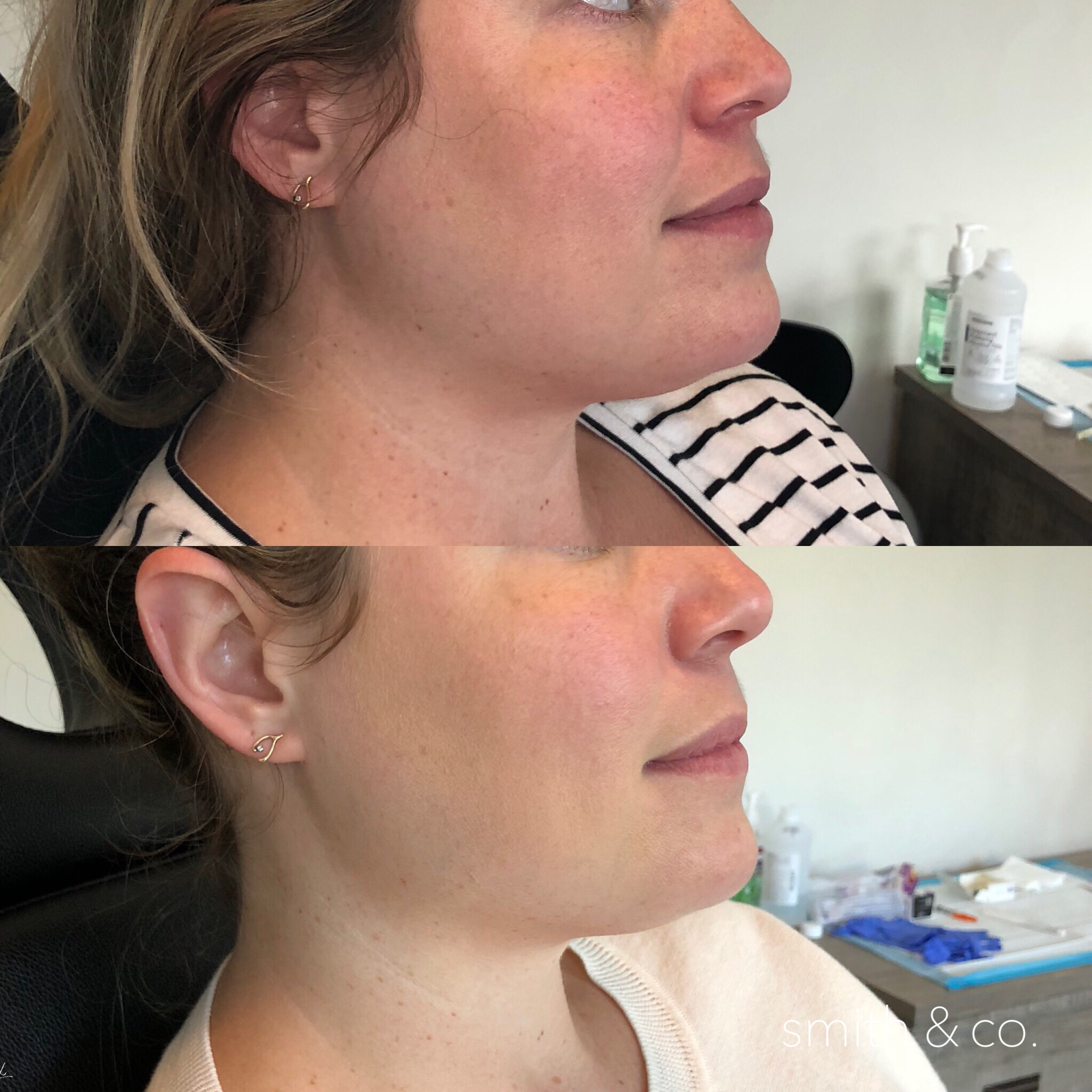 jawline contour with filler and kybella