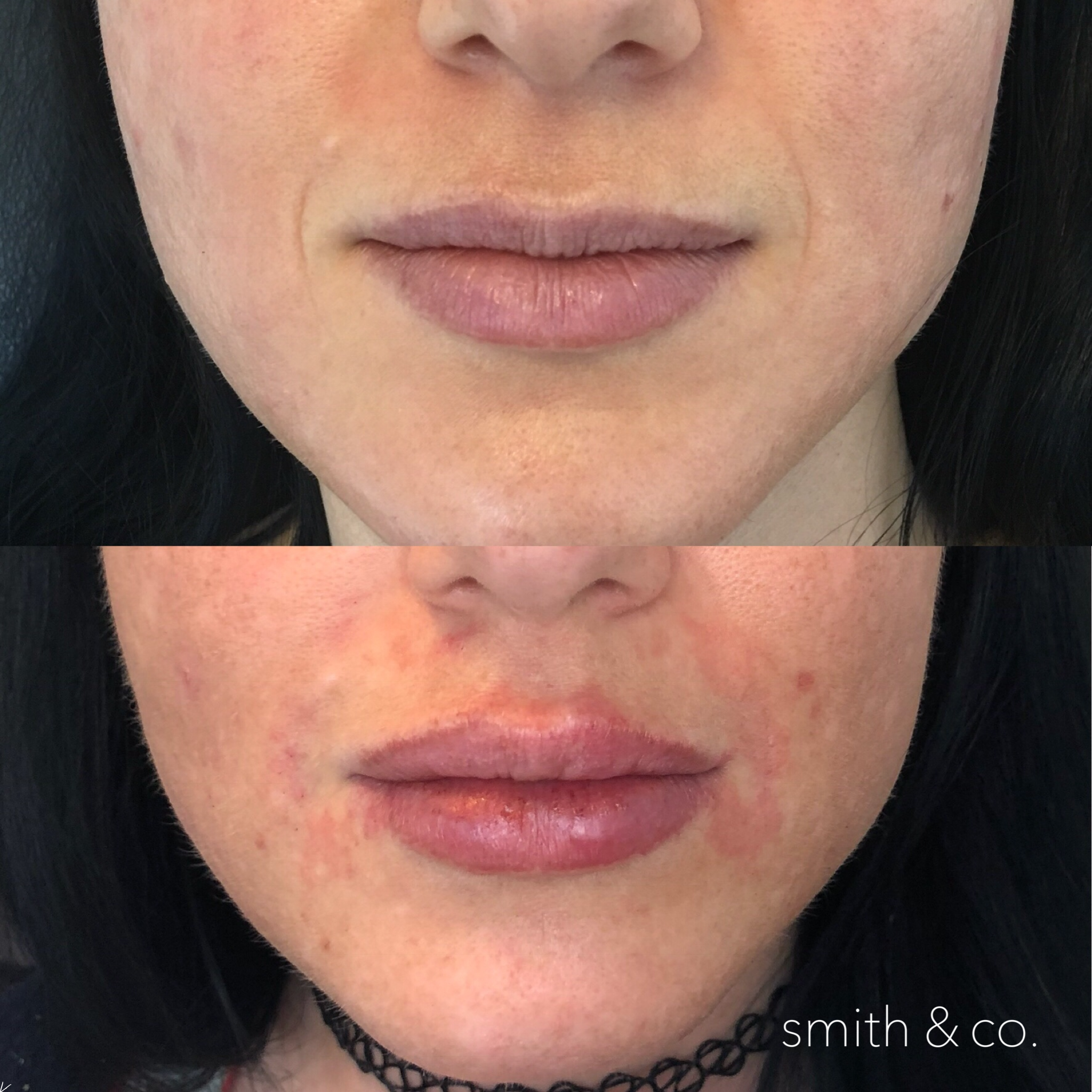 smith & co best botox and filler in mimai_9542.PNG