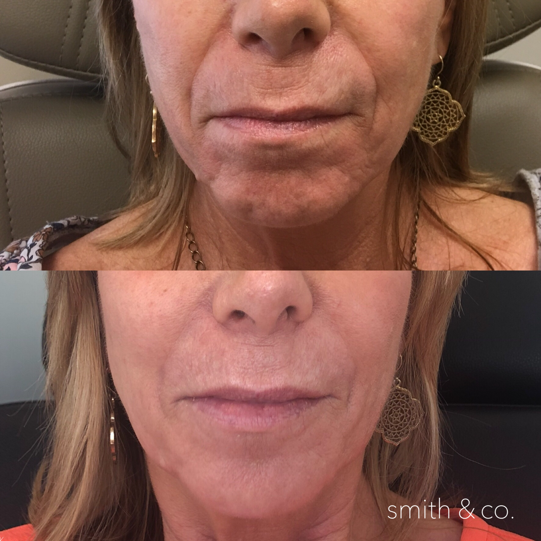 smith & co best botox and filler in mimai_9454.PNG