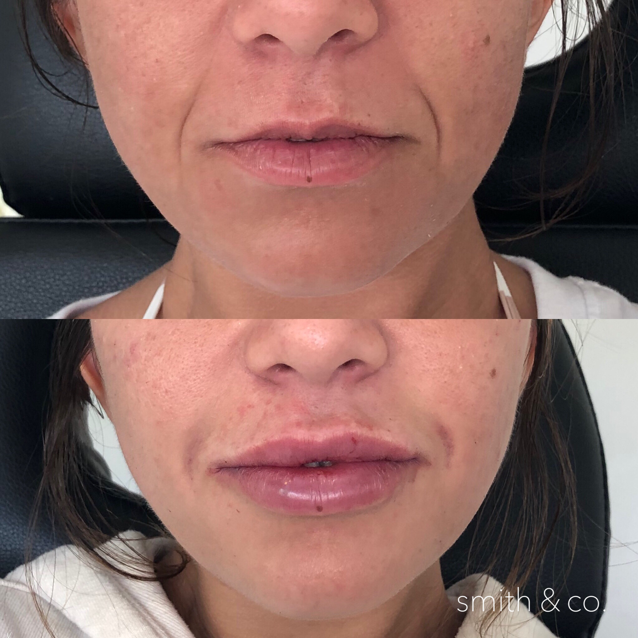 smith & co best lip injections in miami best botox specialist smile lines with restylane.PNG