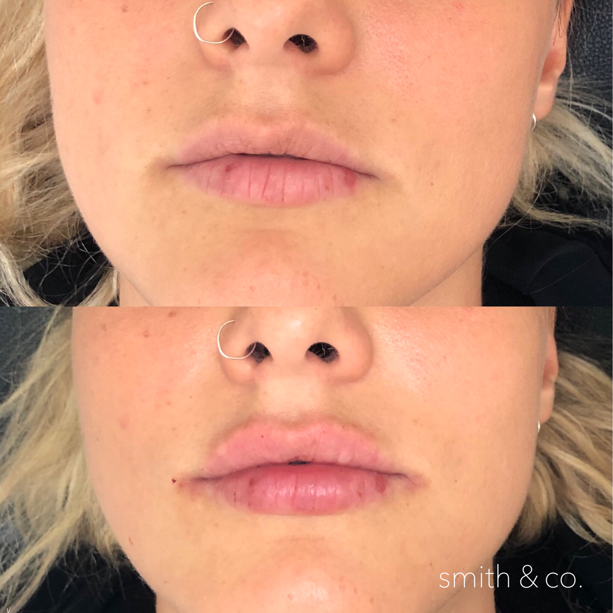smith & co best lip injections in miami best botox specialist juvederm lips.PNG