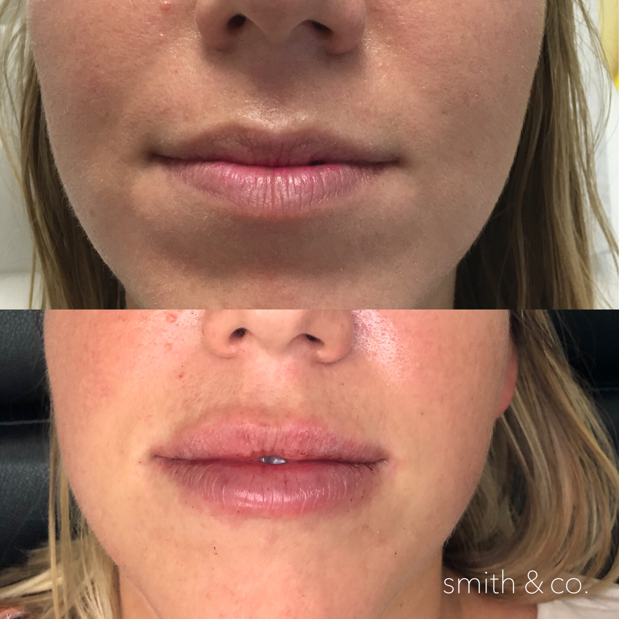 smith & co best lip fillers in miami restylane.PNG