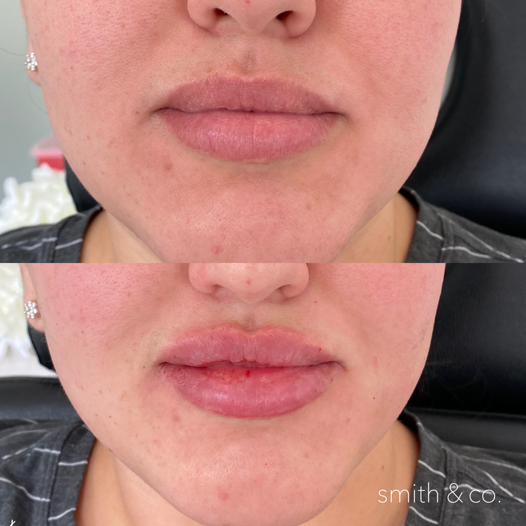 smith & co best botox and filler in mimai_1719.PNG