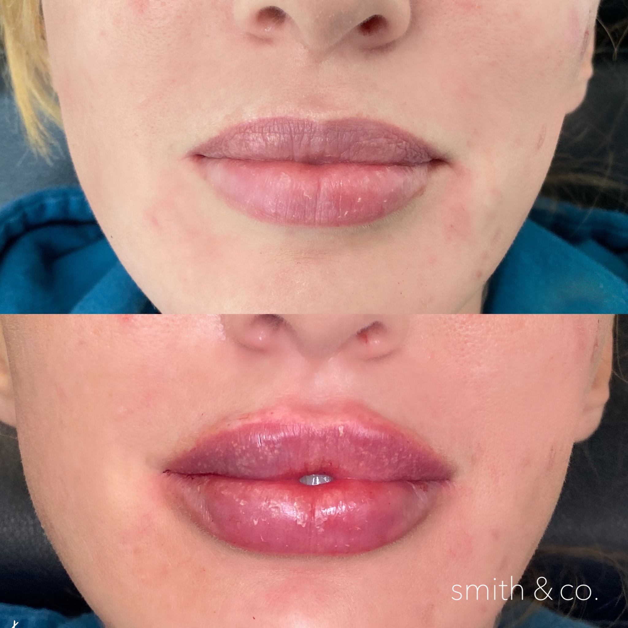 smith & co best botox and filler in mimai_1721.PNG