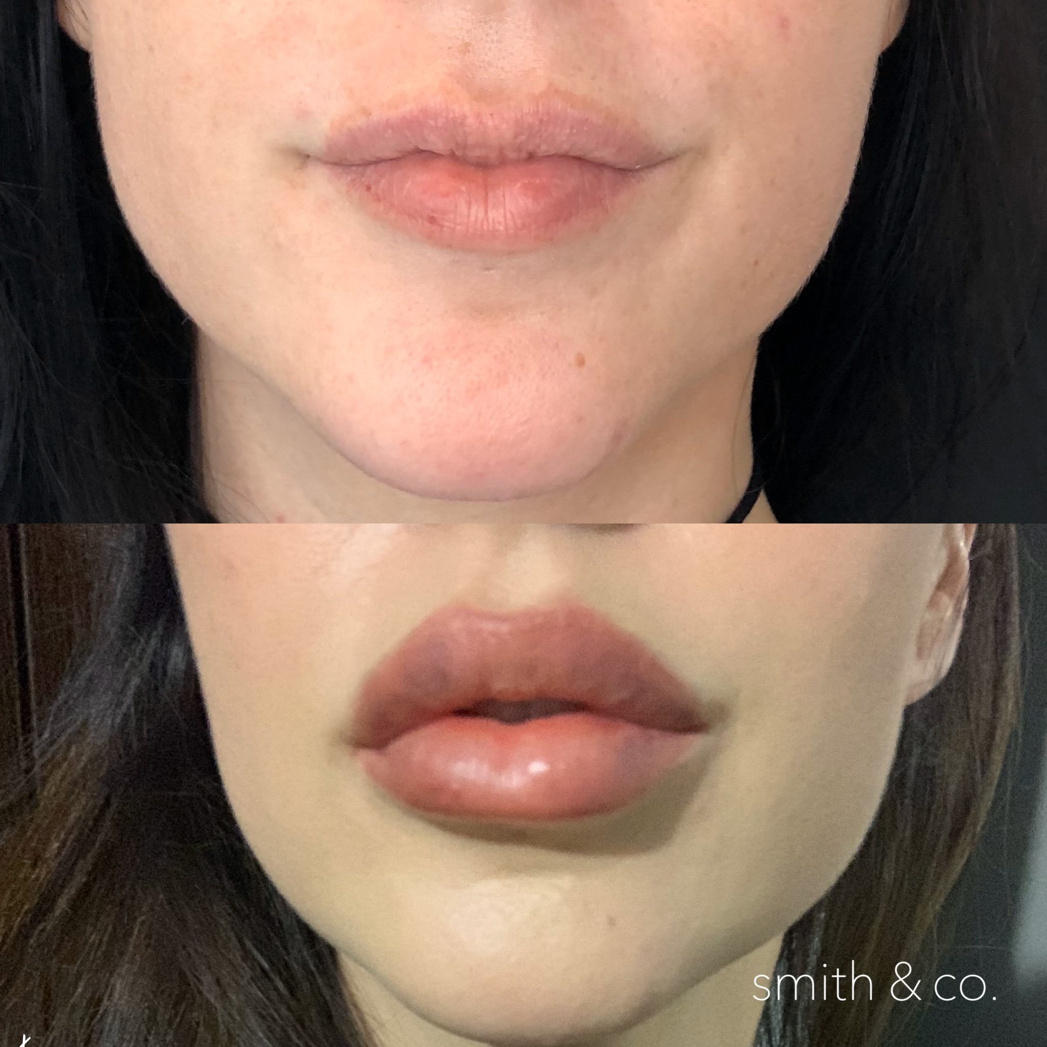 smith & co best botox and filler in mimai_1728.PNG