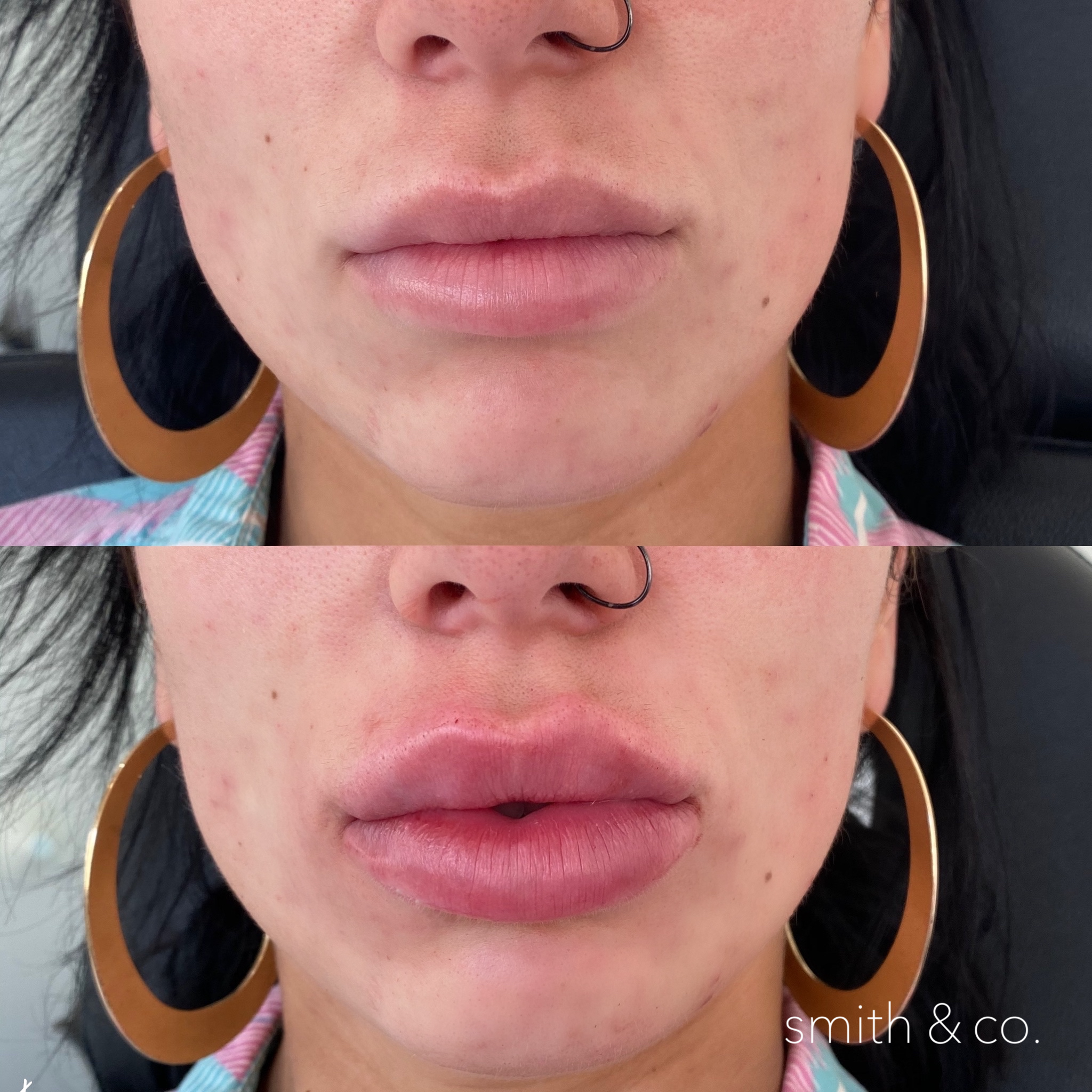 smith & co best botox and filler in mimai_1735.PNG