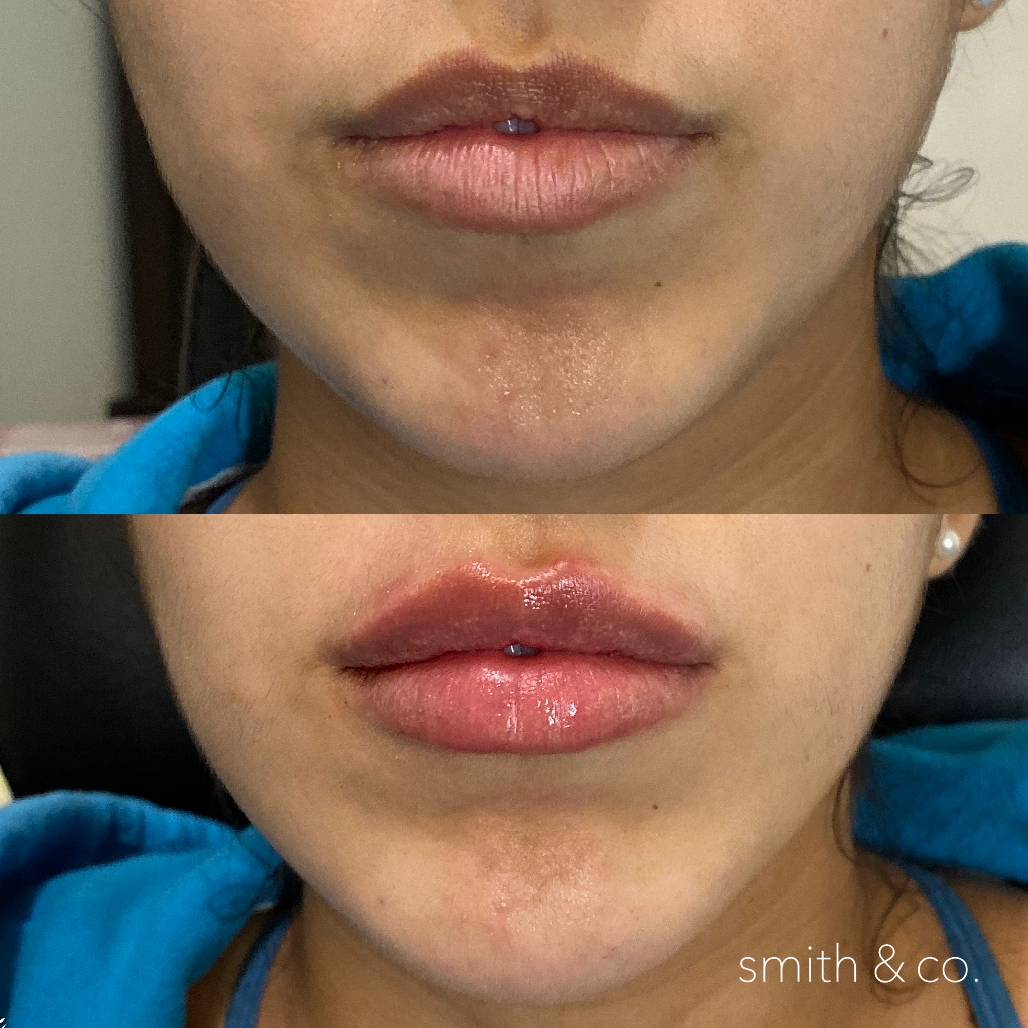 smith & co best botox and filler in mimai_1787.PNG