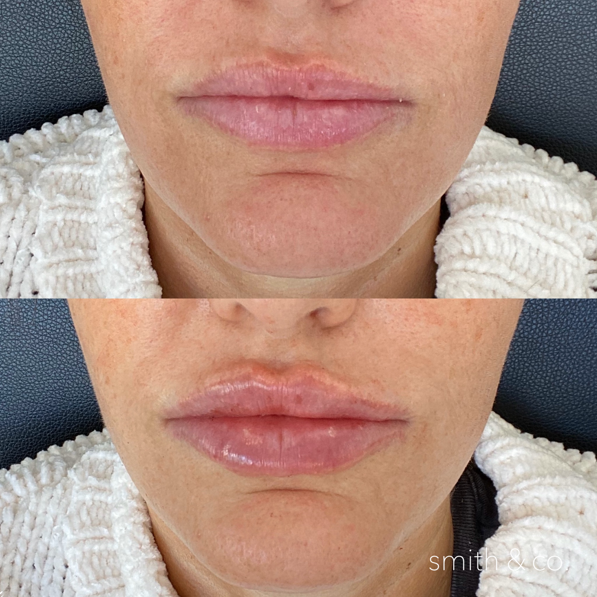 smith & co best botox and filler in mimai_1789.PNG