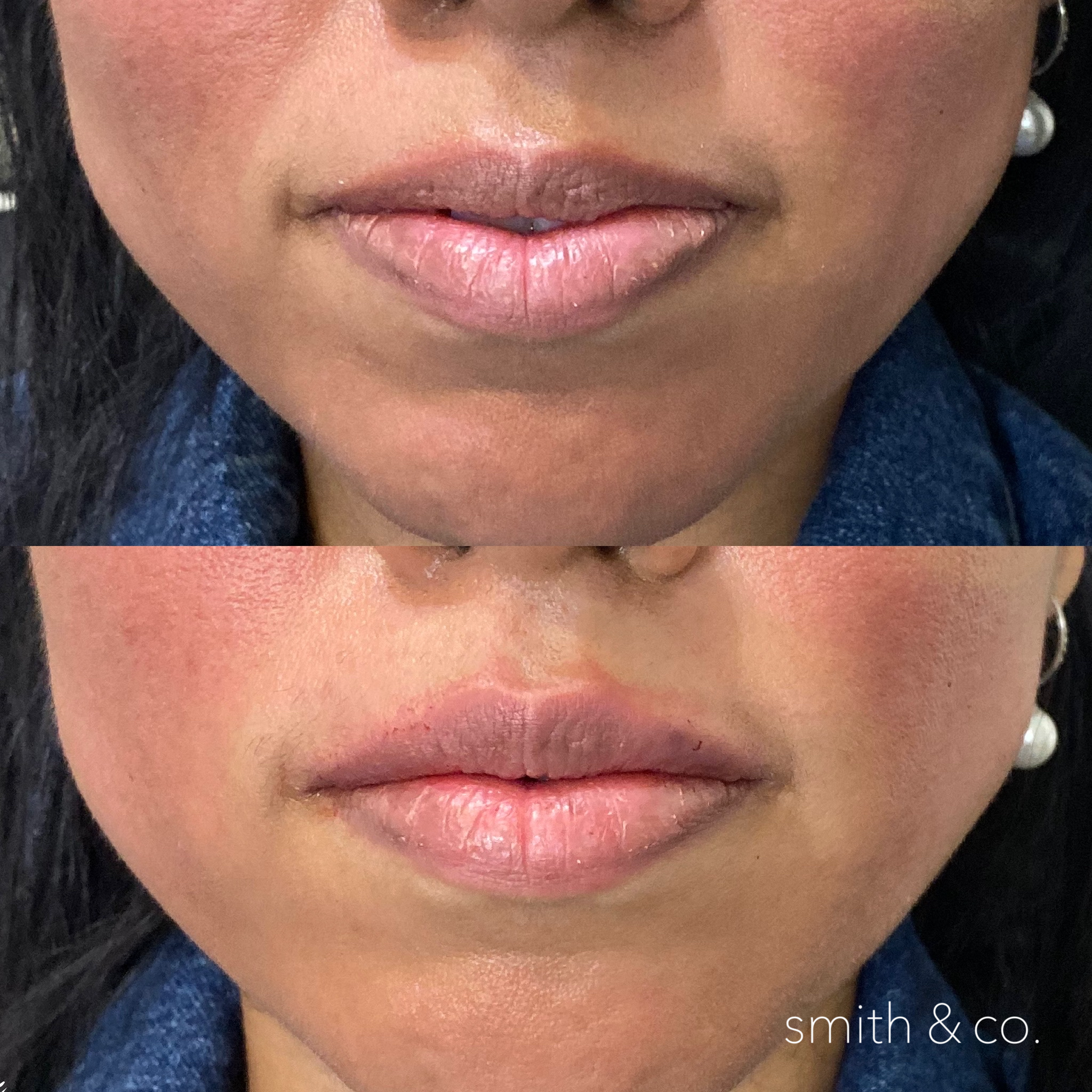smith & co best botox and filler in mimai_1791.PNG
