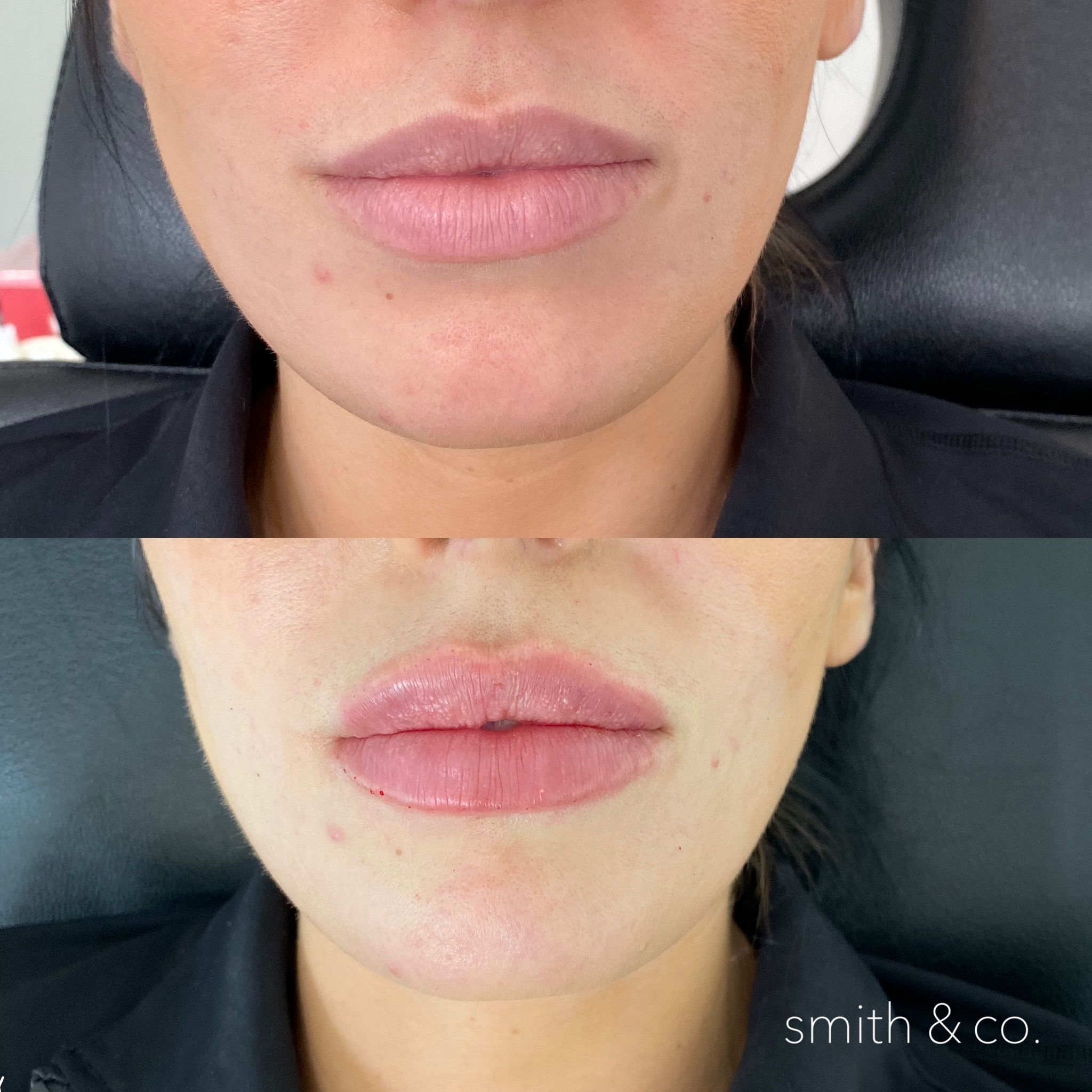 smith & co best botox and filler in mimai_1893.PNG