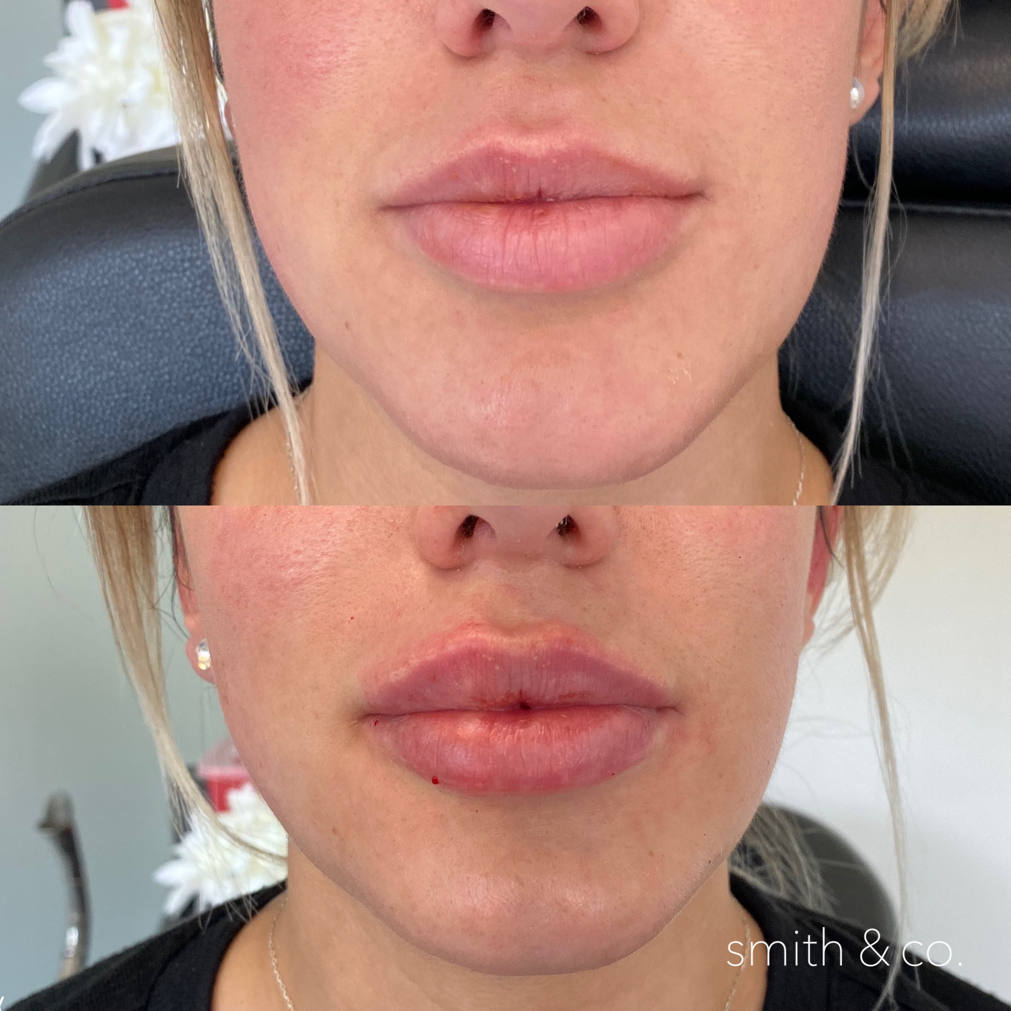 smith & co best botox and filler in mimai_1891.PNG