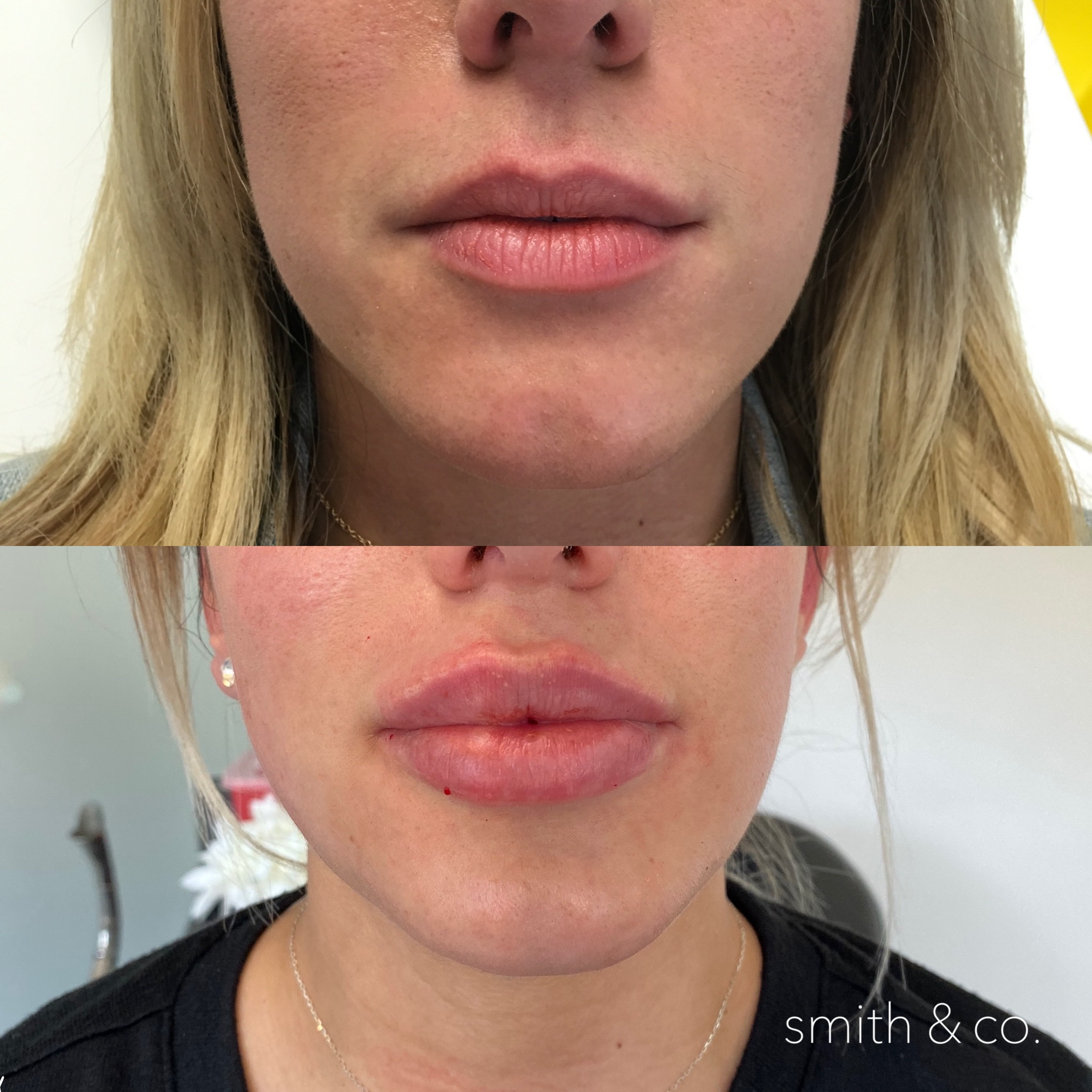 smith & co best botox and filler in mimai_1897.PNG