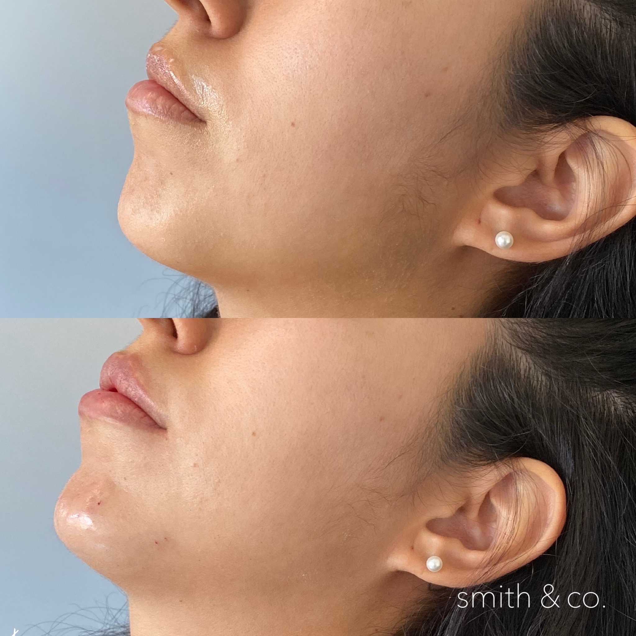 jawline contour with filler