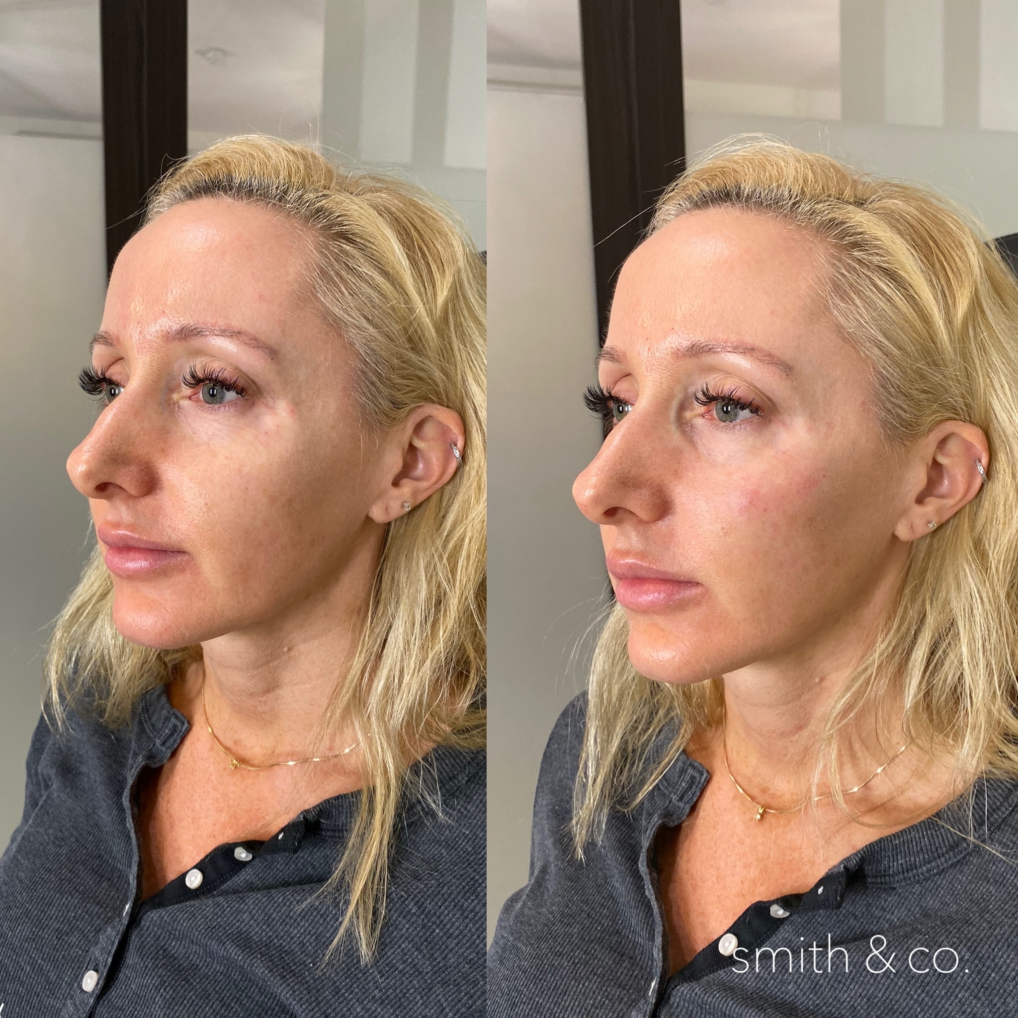 jawline contour with filler, cheek and temple filler
