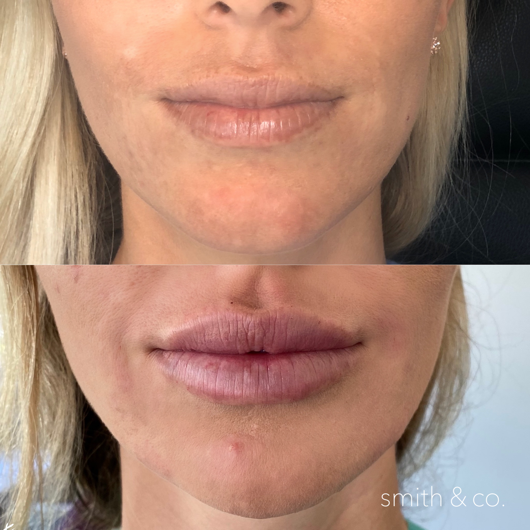 smith & co best botox and filler in miami_1961.PNG
