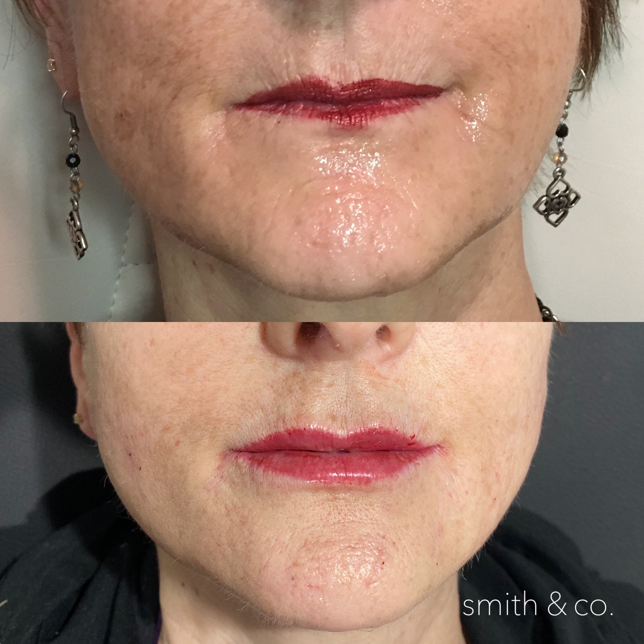 smith & co best botox and filler in miami_2174.PNG