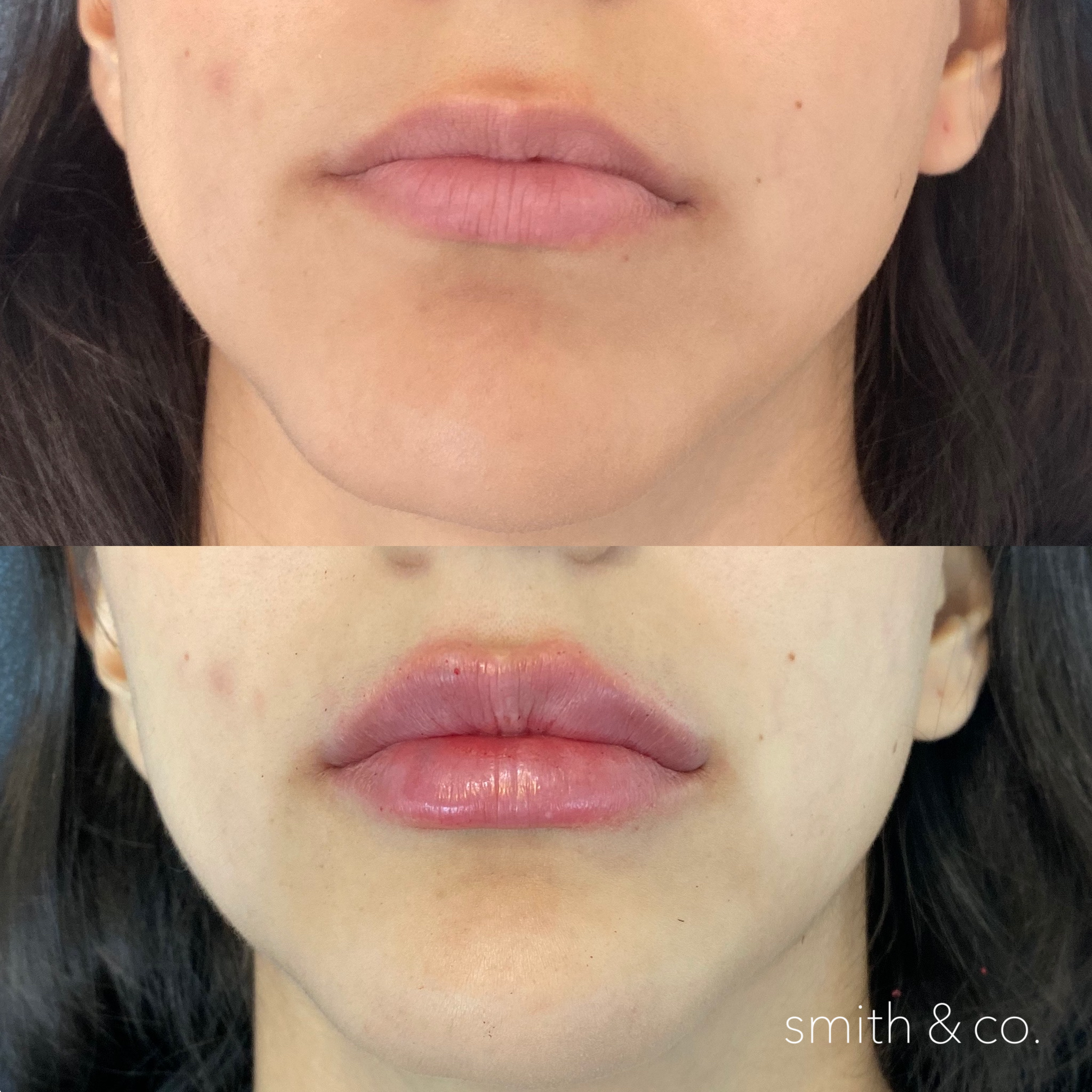 smith & co best botox and filler in miami_2178.PNG