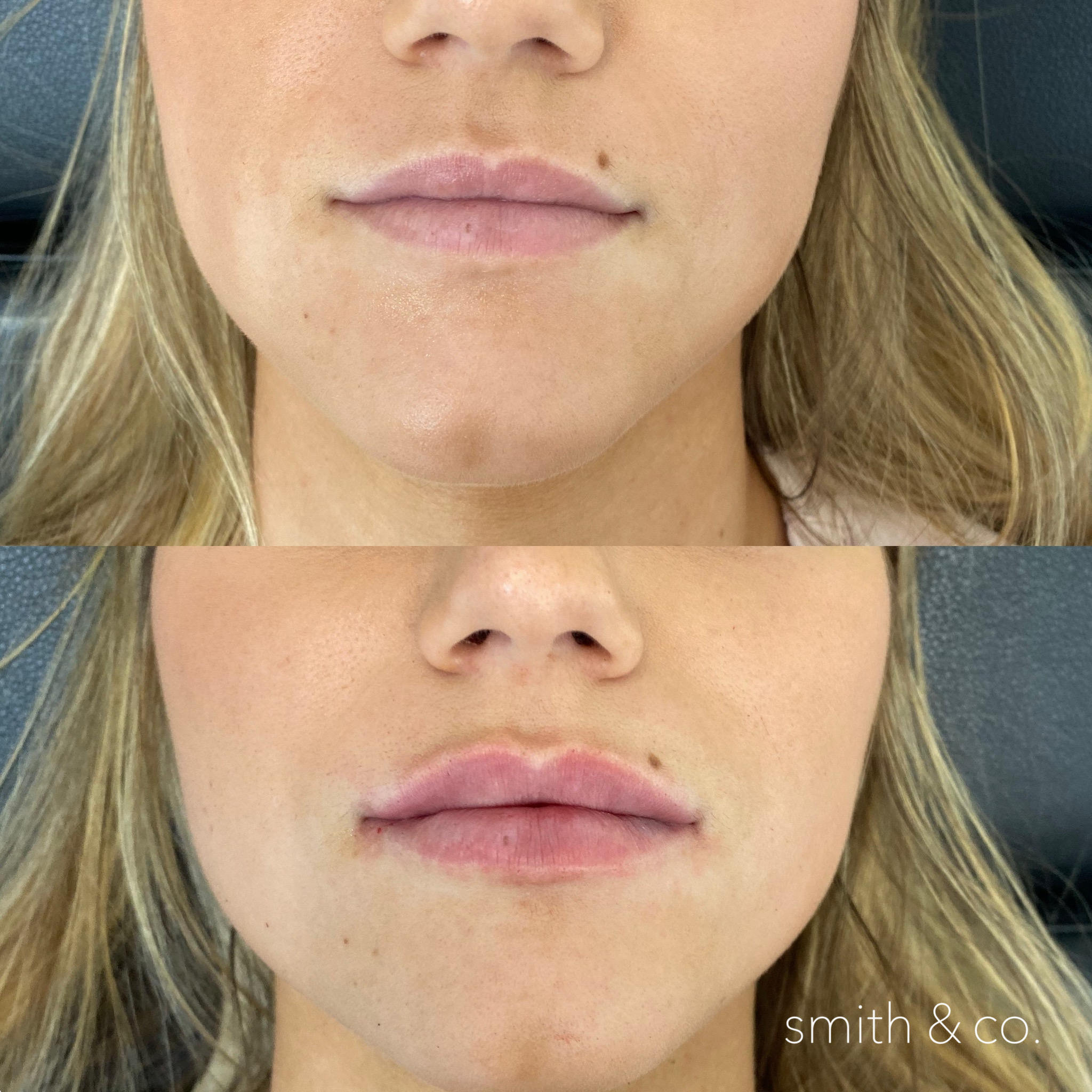 smith & co best botox and filler in miami_2181.PNG