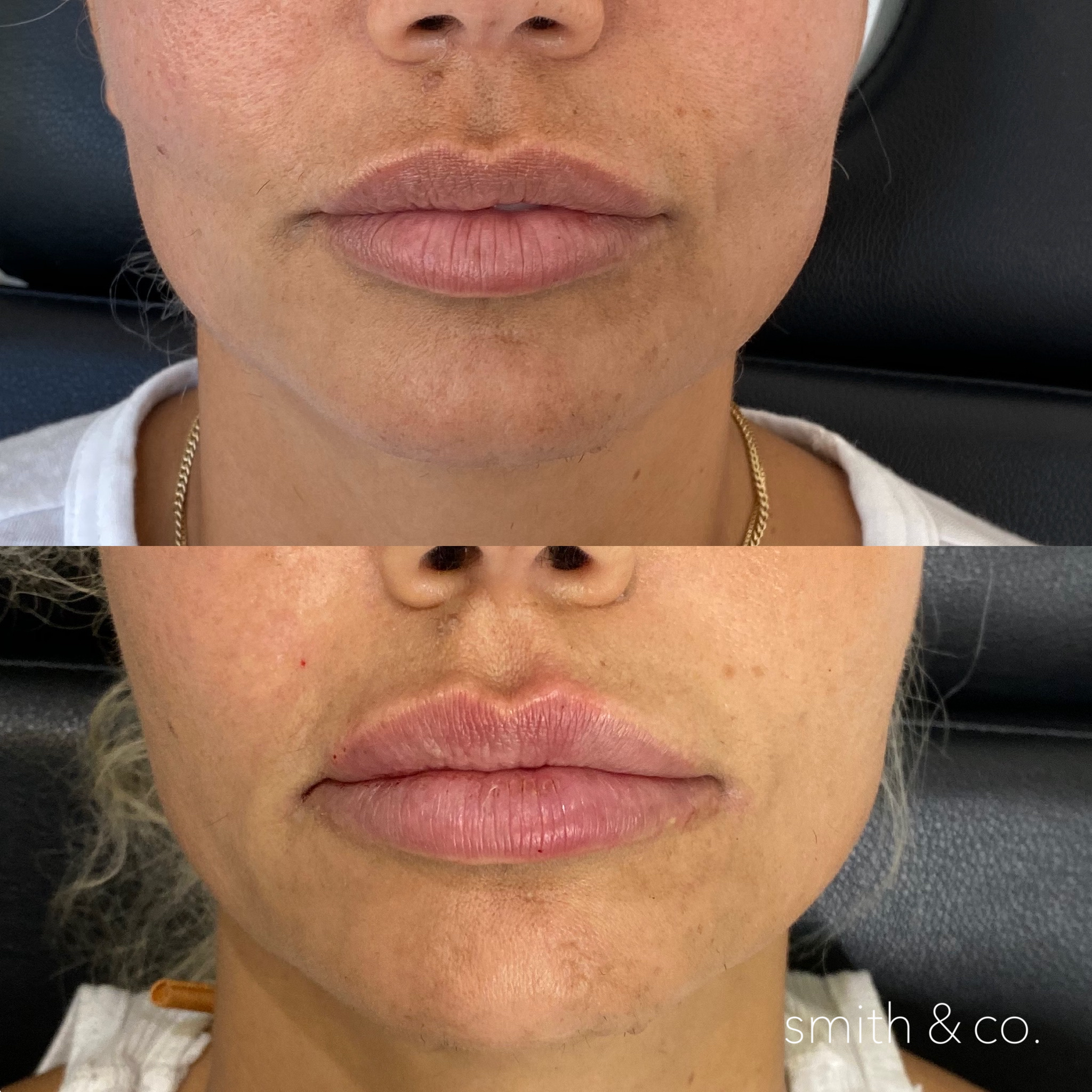 smith & co best botox and filler in miami_2185.PNG