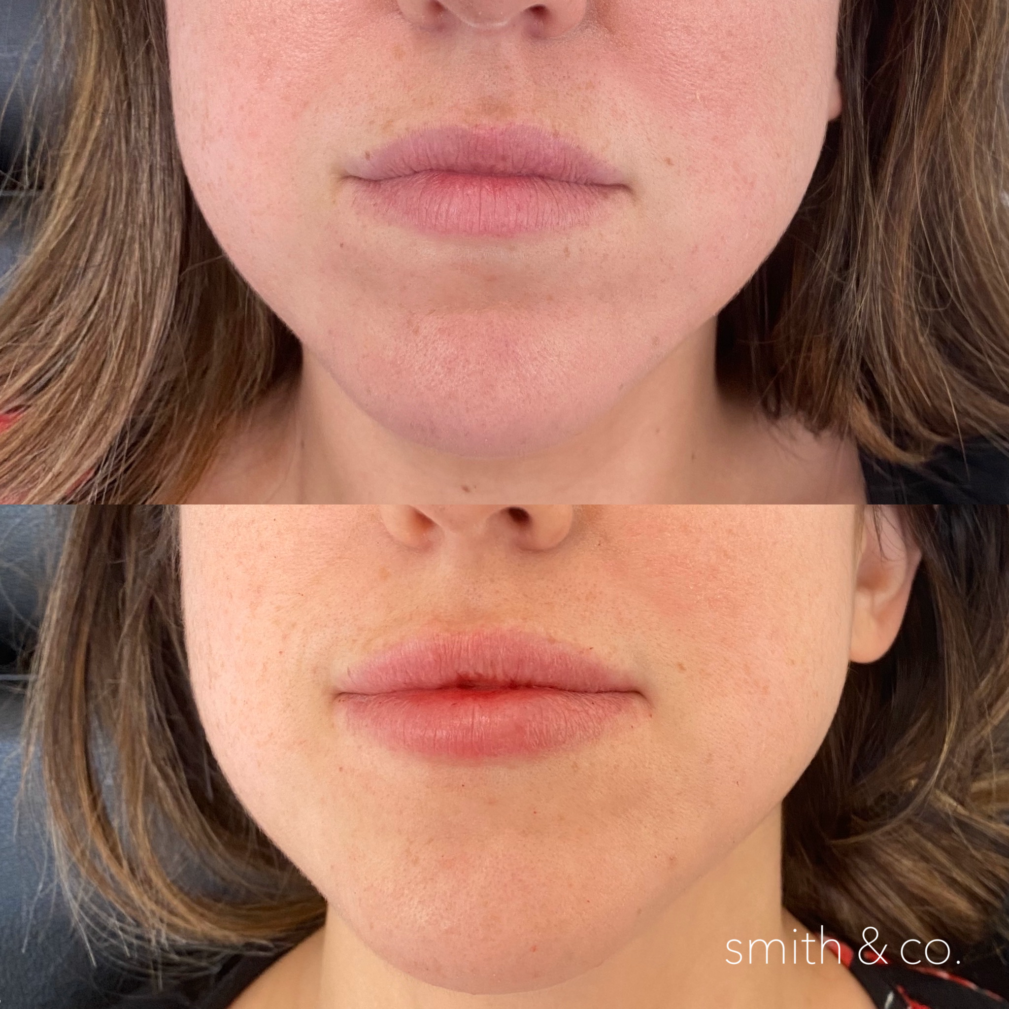 smith & co best botox and filler in miami_2614.PNG