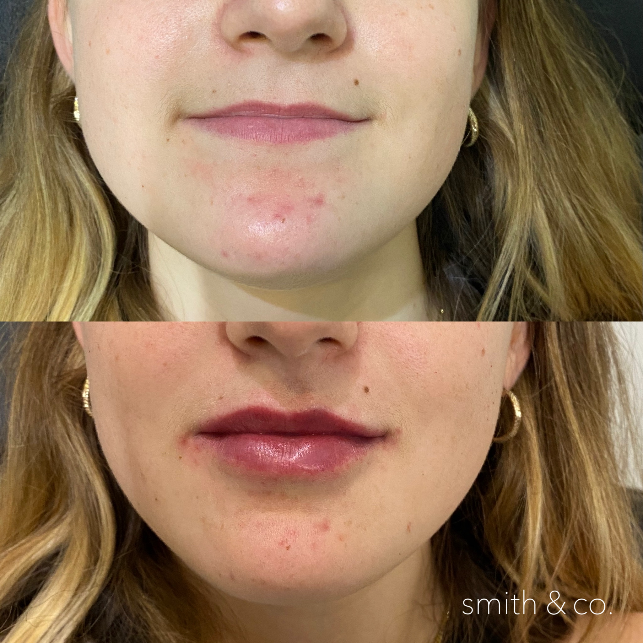 smith & co best botox and filler in miami_2627.PNG