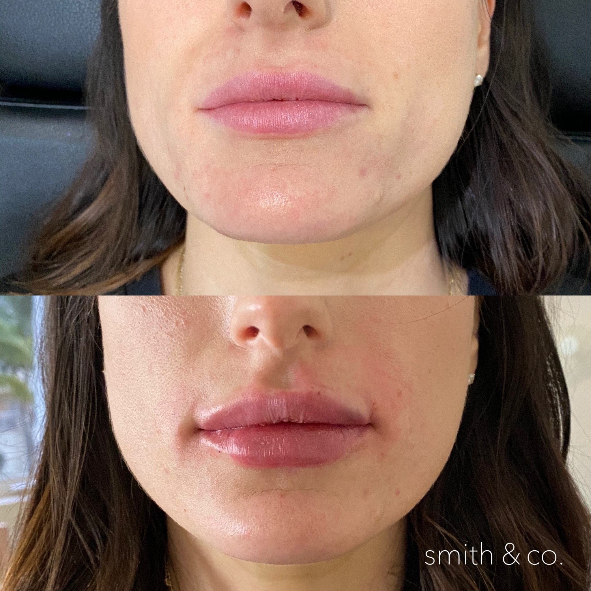 smith & co best botox and filler in miami_2637.PNG