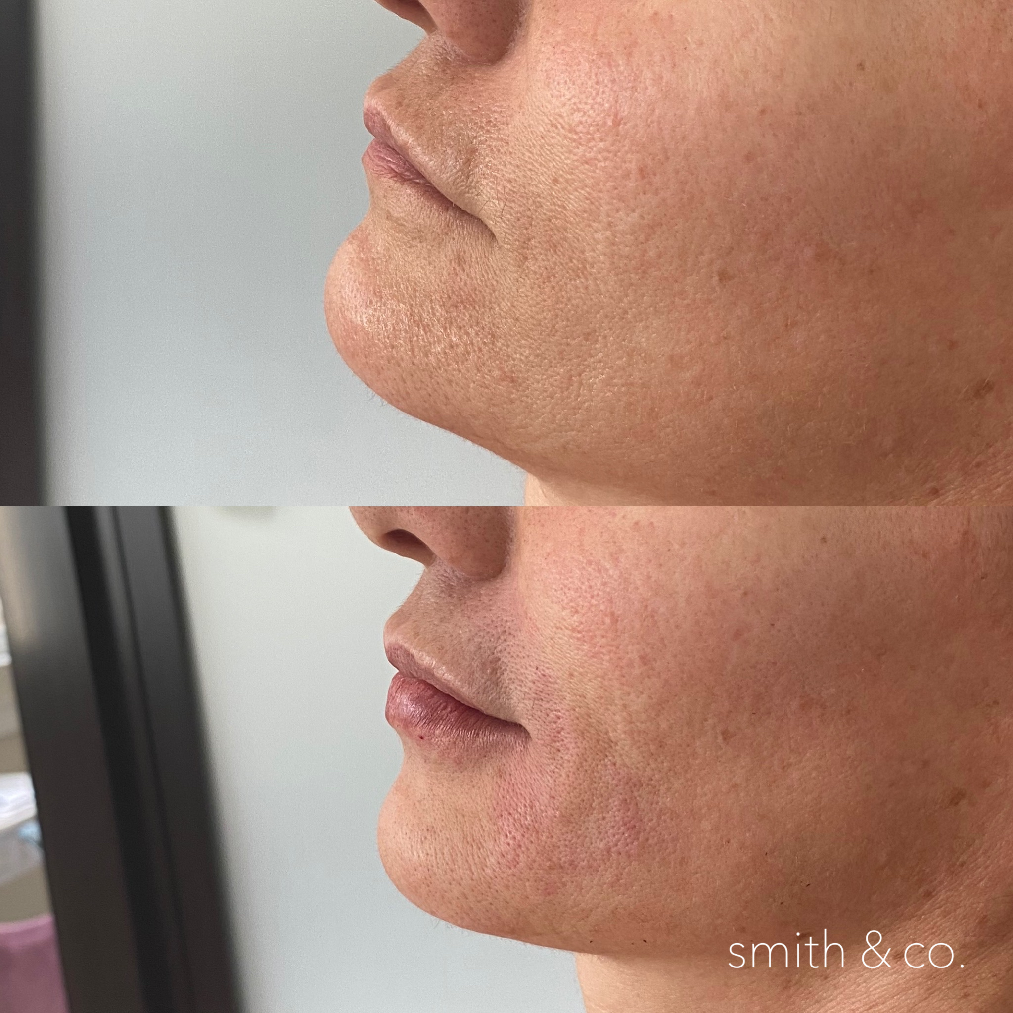 smith & co best botox and filler in miami_2610.PNG