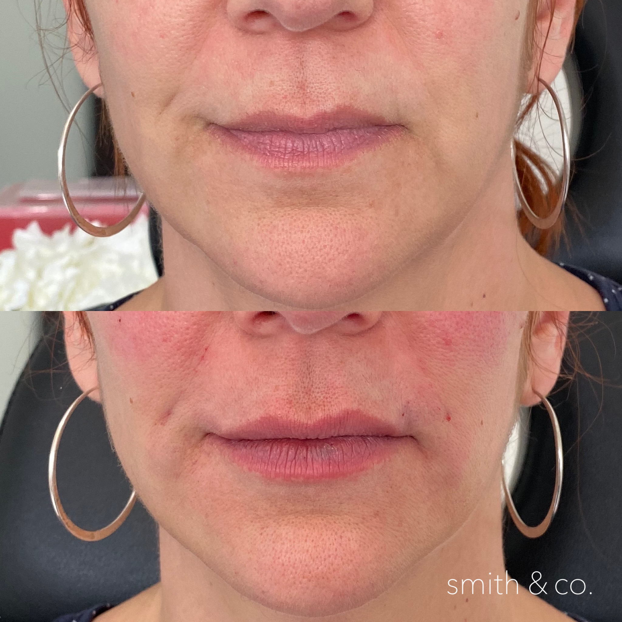 smith & co best botox and filler in miami_2644.PNG