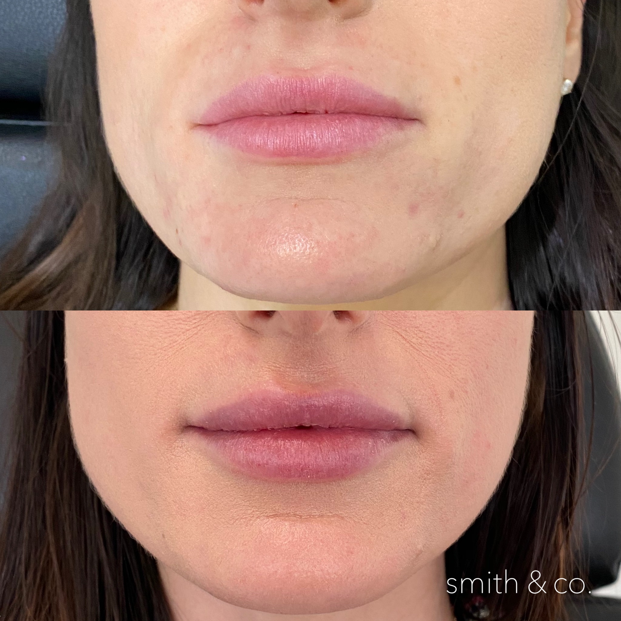 smith & co best botox and filler in miami_2635.PNG