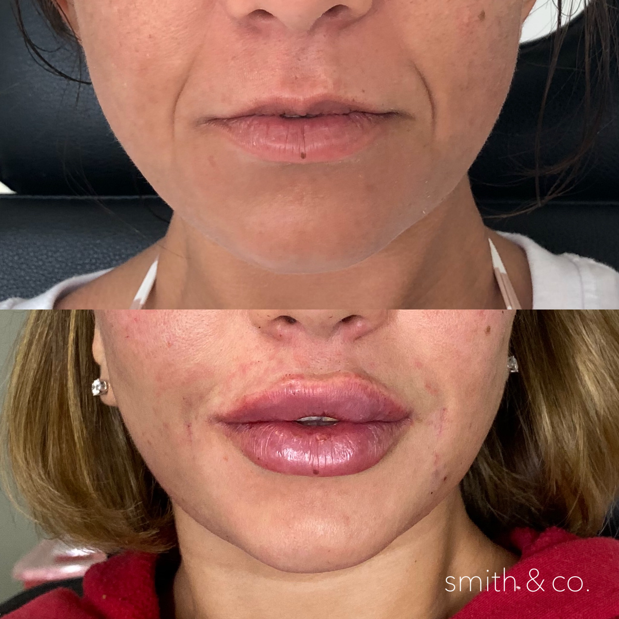 smith & co best botox and filler in miami_2646.PNG